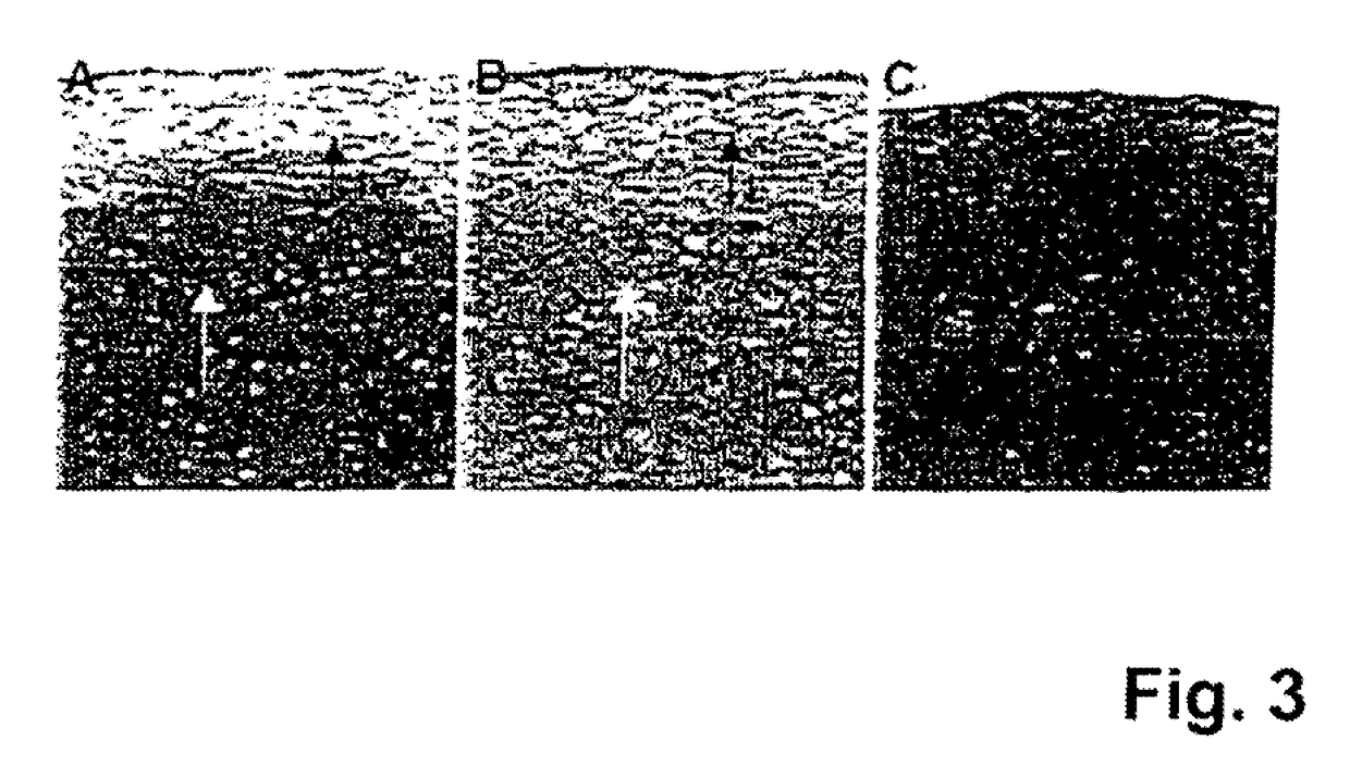 Implant for Repairing a Cartilage Defect