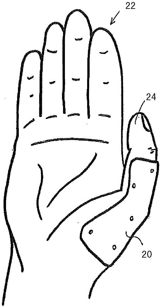 Thumb orthosis