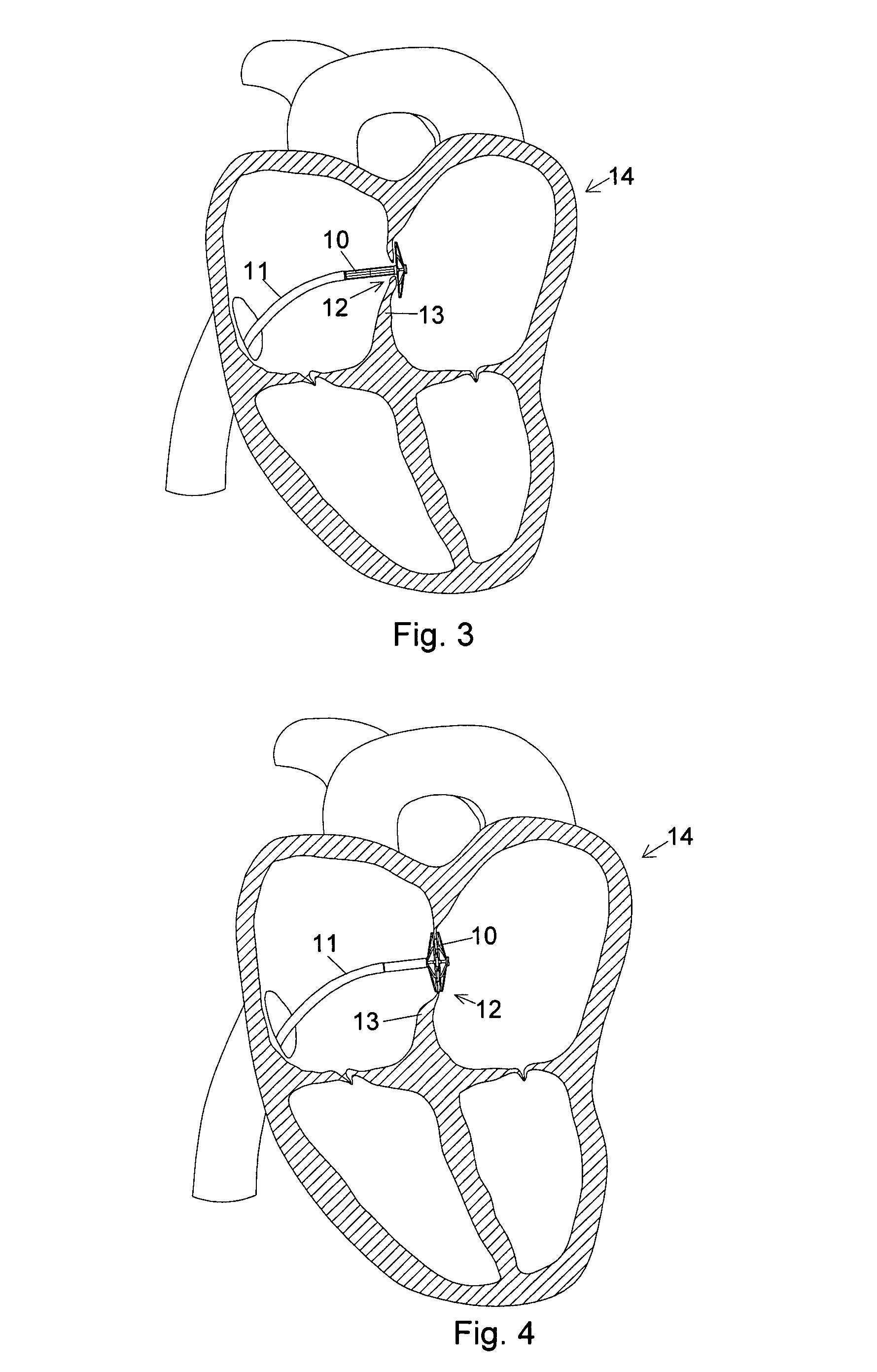Closure device and insertion assembly