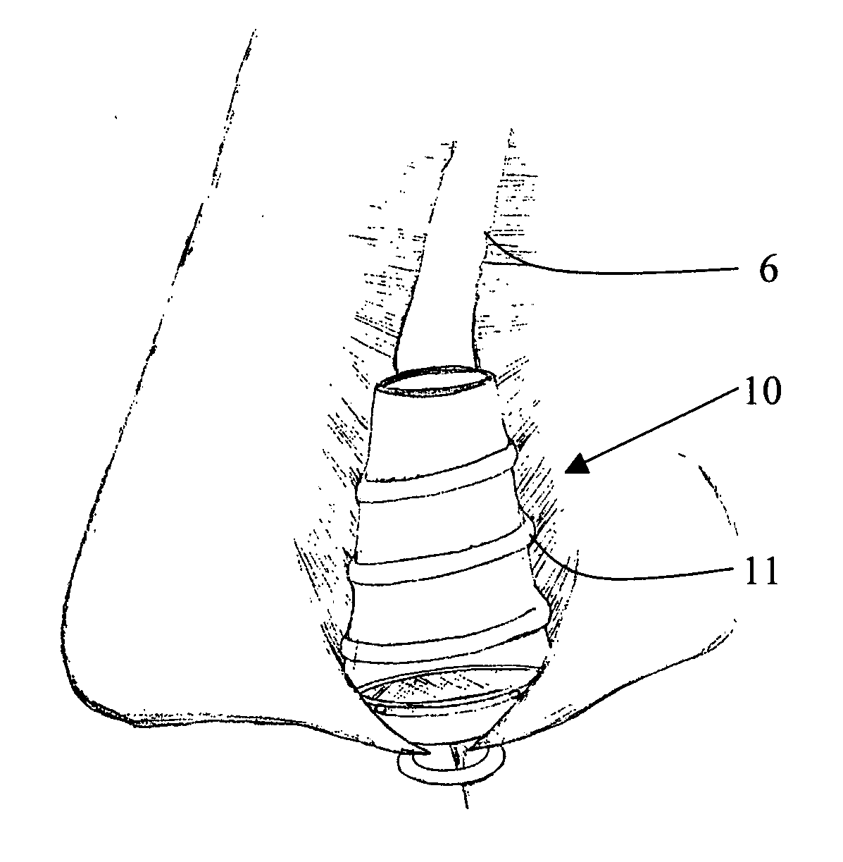 Nose device