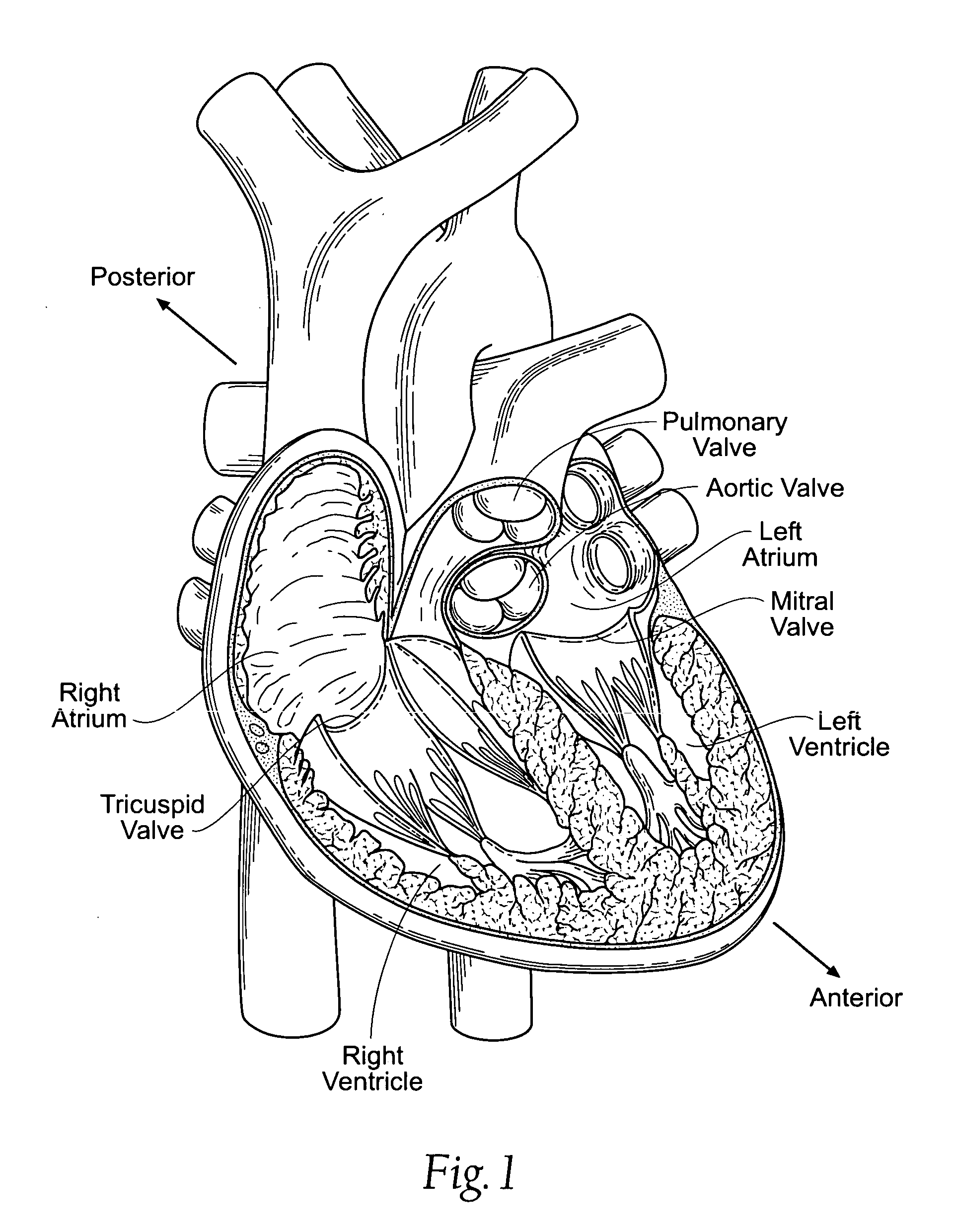 Devices, systems, and methods for reshaping a heart valve annulus, including the use of an adjustable bridge implant system
