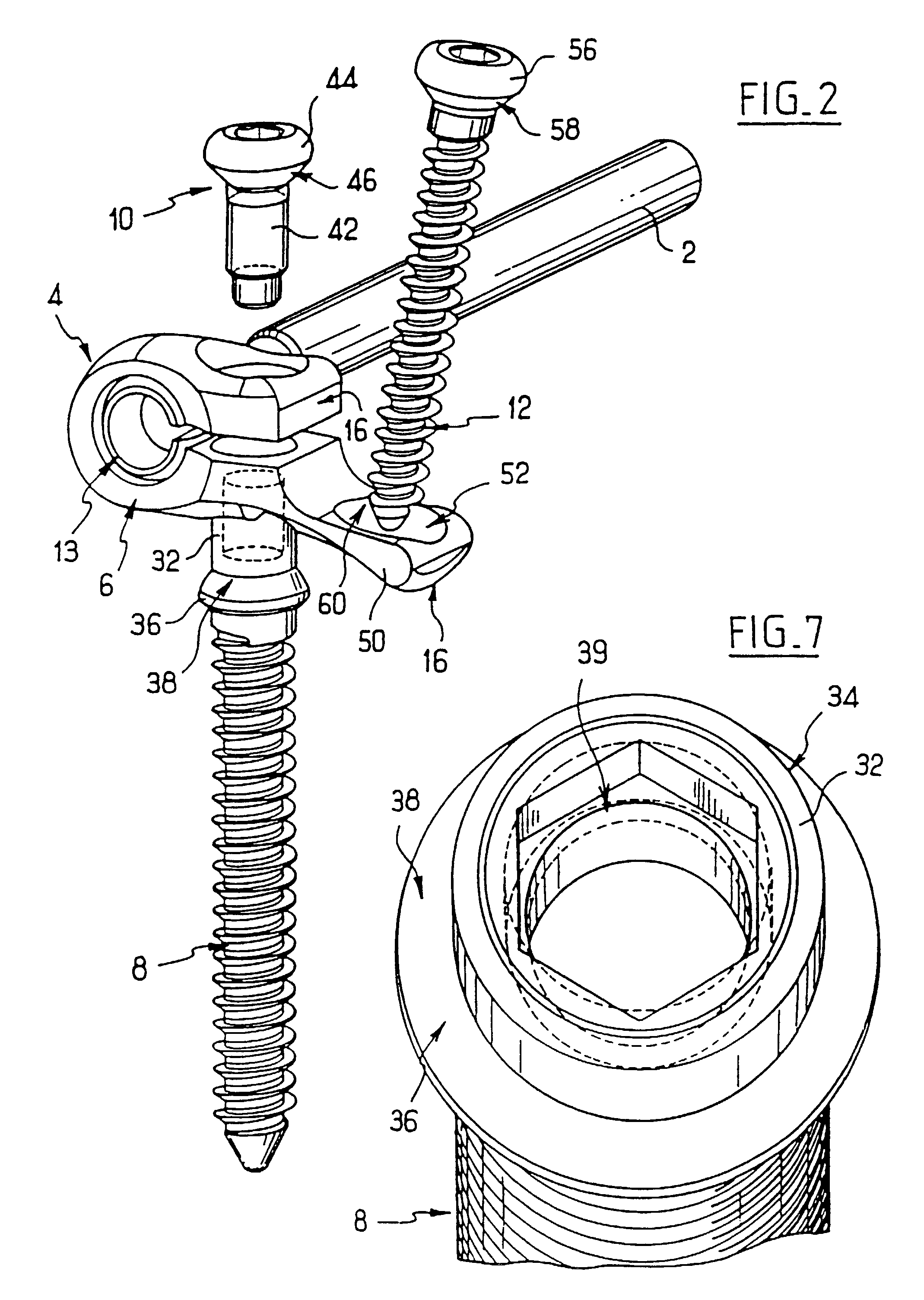 Spinal osteosynthesis system for anterior fixation