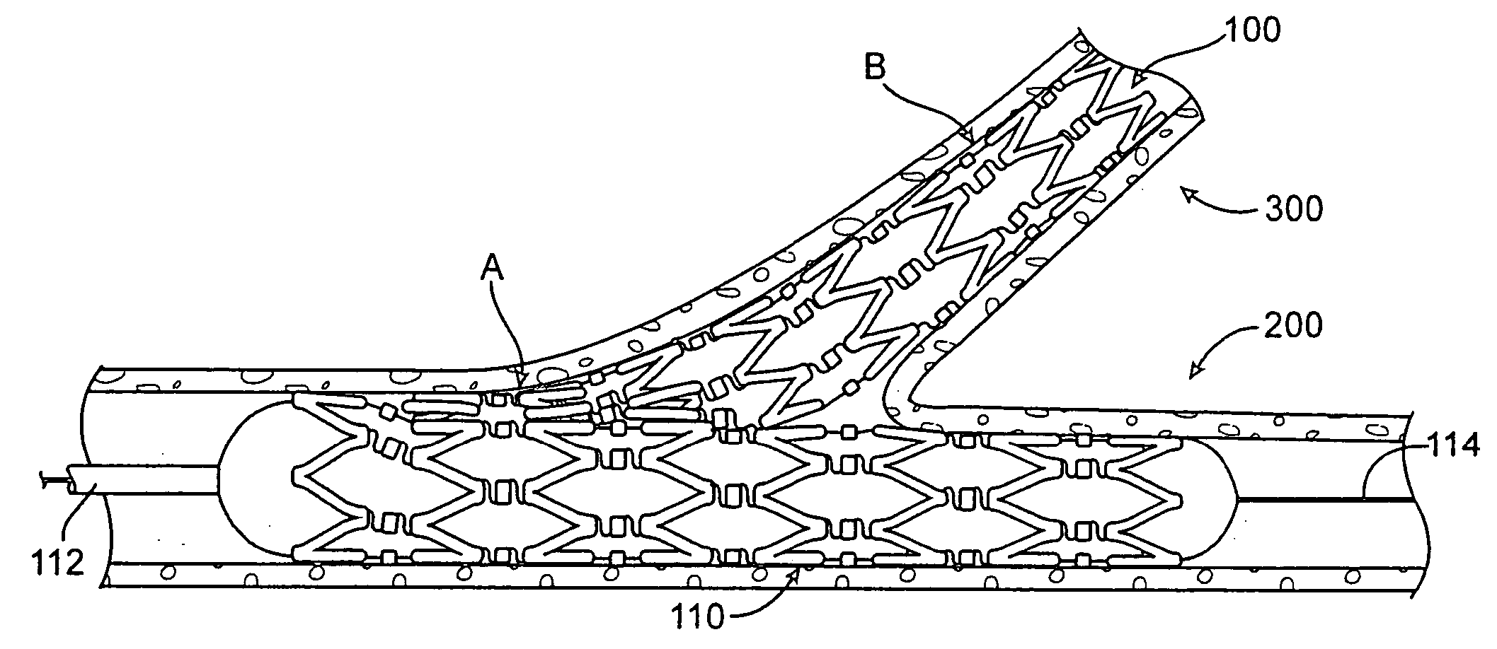 Bifurcation stent with crushable end and method for delivery of a stent to a bifurcation