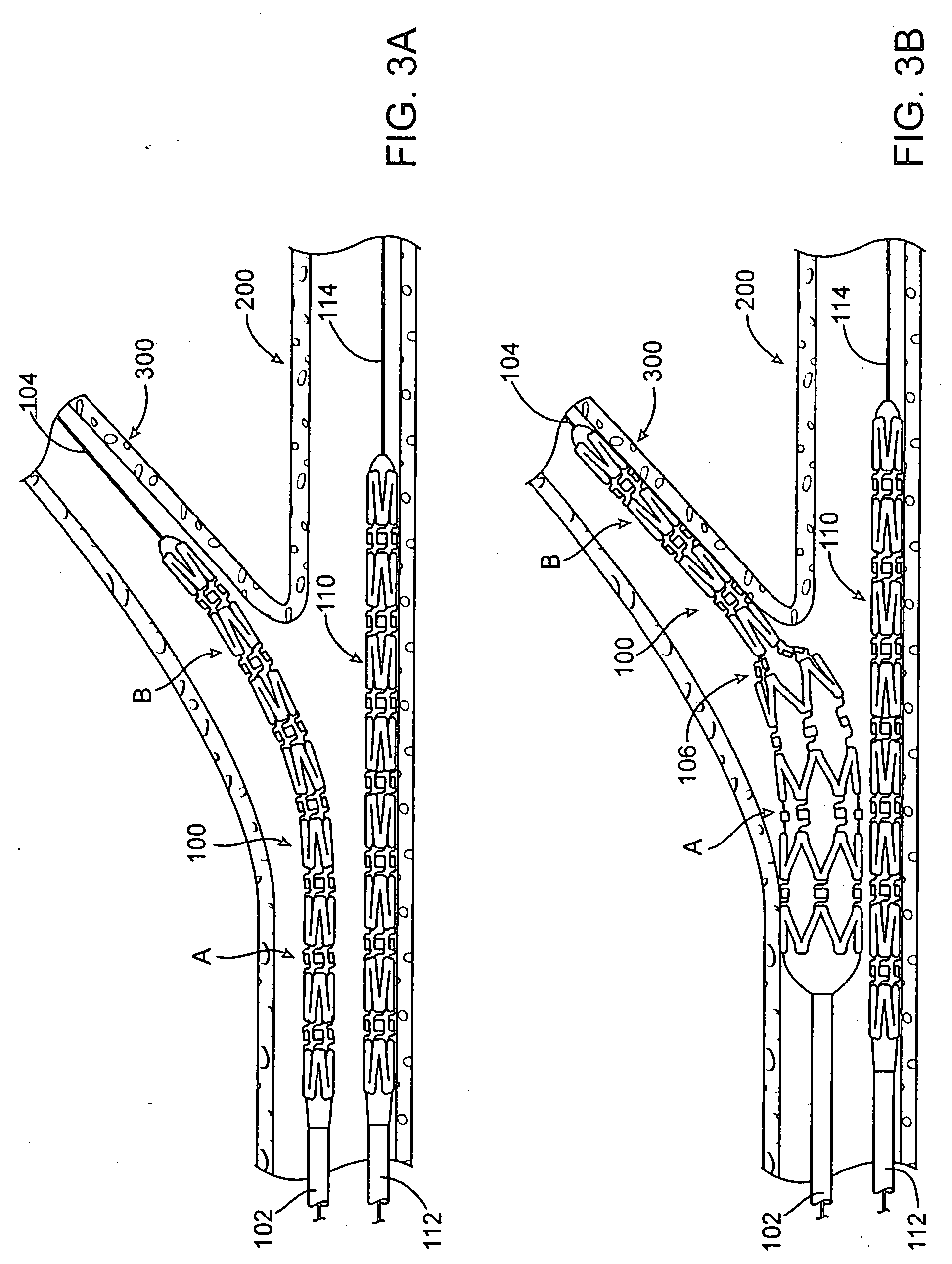 Bifurcation stent with crushable end and method for delivery of a stent to a bifurcation