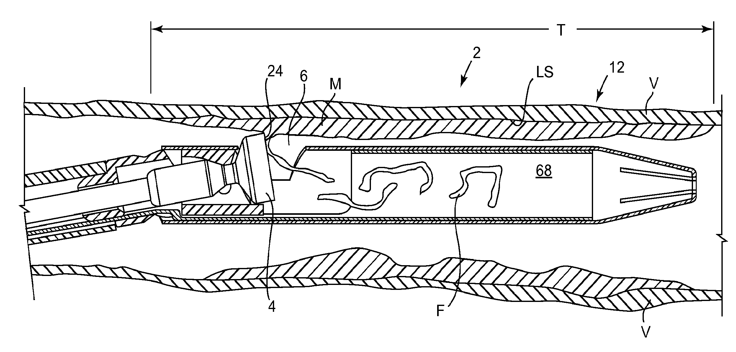 Easily cleaned atherectomy catheters and methods of use