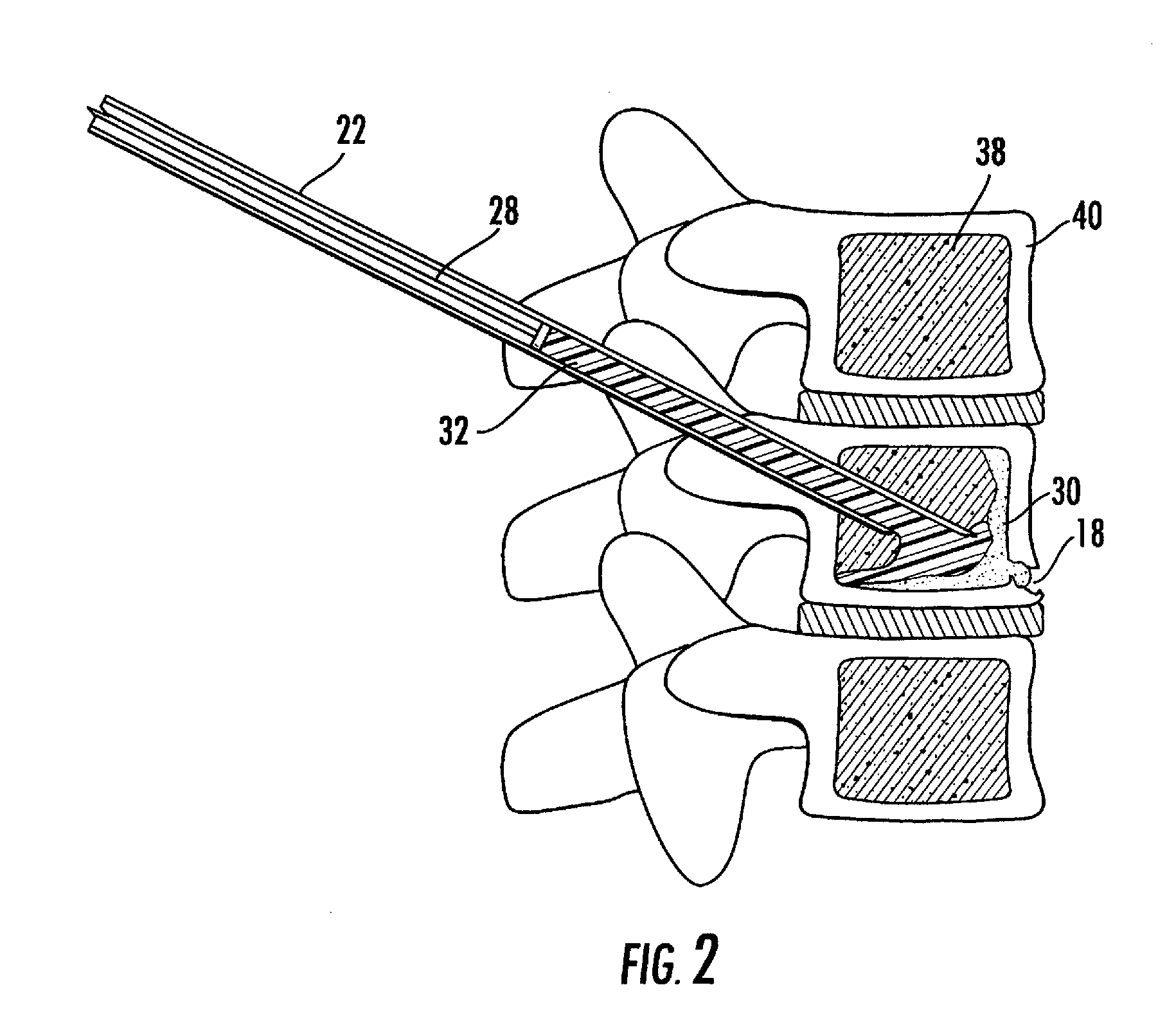 Method and composition for use in reinforcing bone