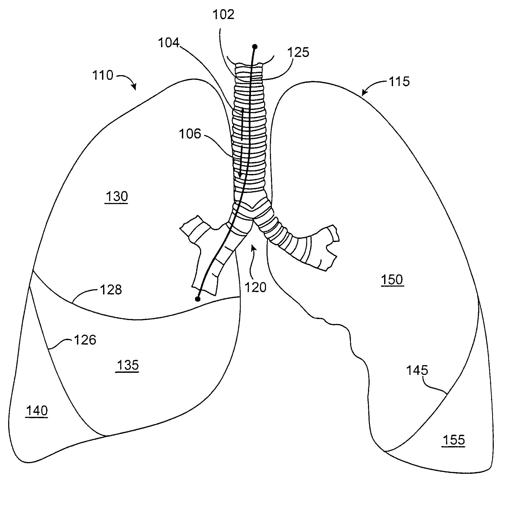 Methods and devices for inducing collapse in lung regions fed by collateral pathways