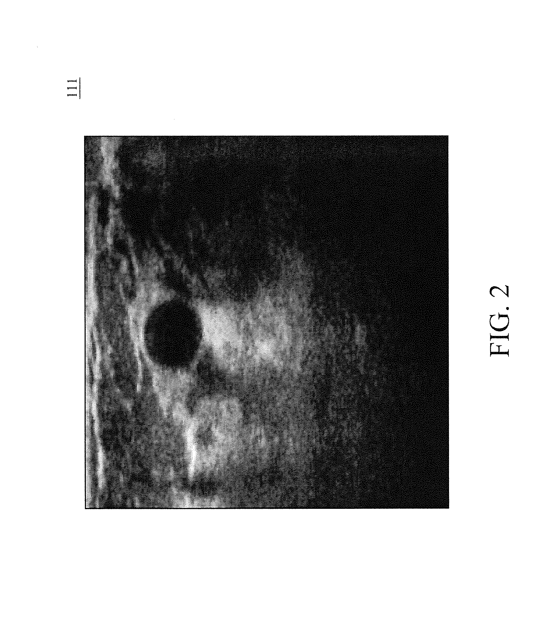 Ultrasound imaging breast tumor detection and diagnostic system and method
