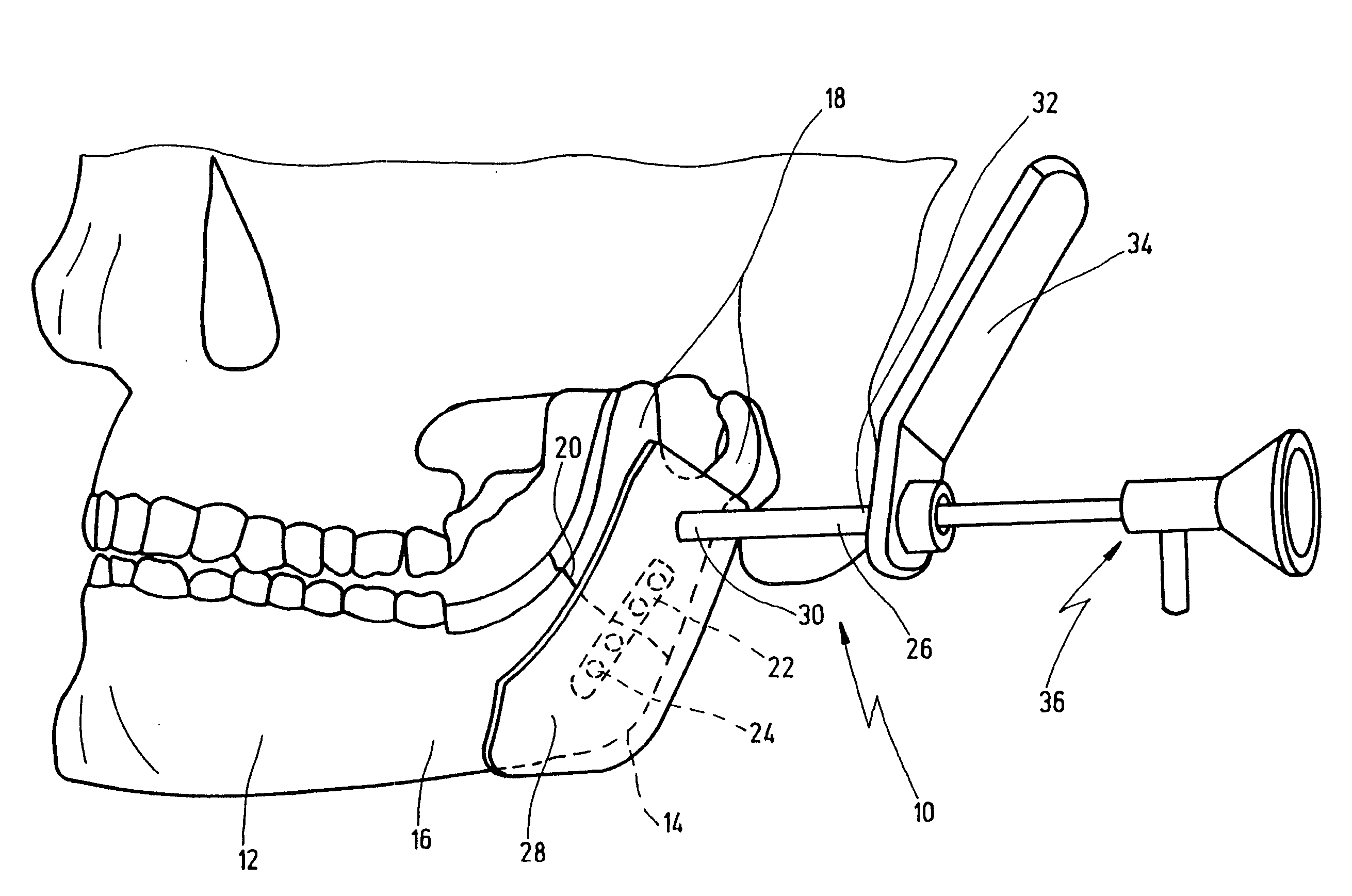 Medical instrument set and method for creating a surgical operating space in operations on the jaw