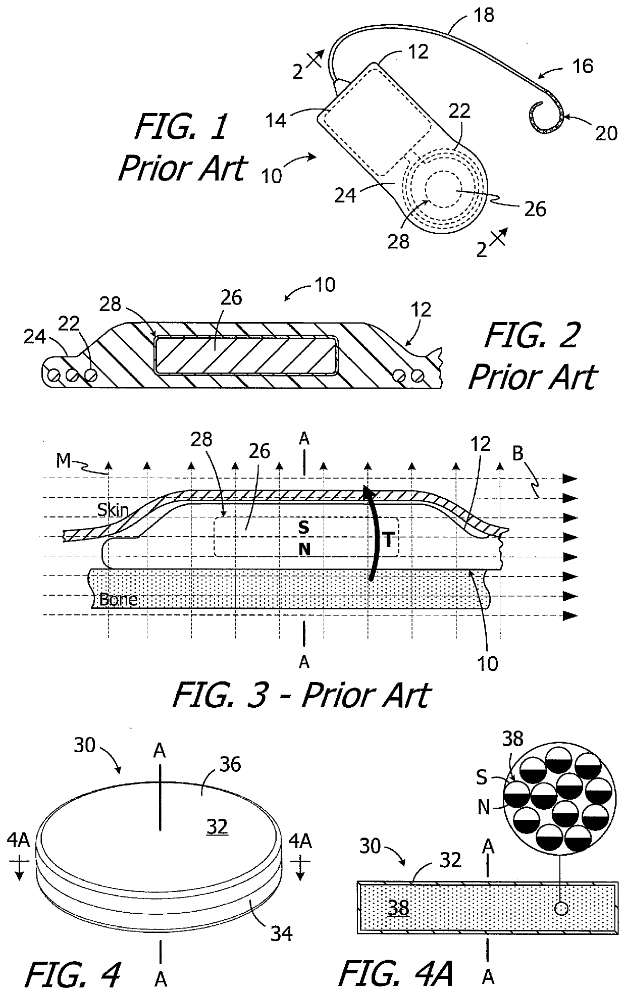 Methods and apparatus for use with cochlear implants having magnet apparatus with magnetic material particles