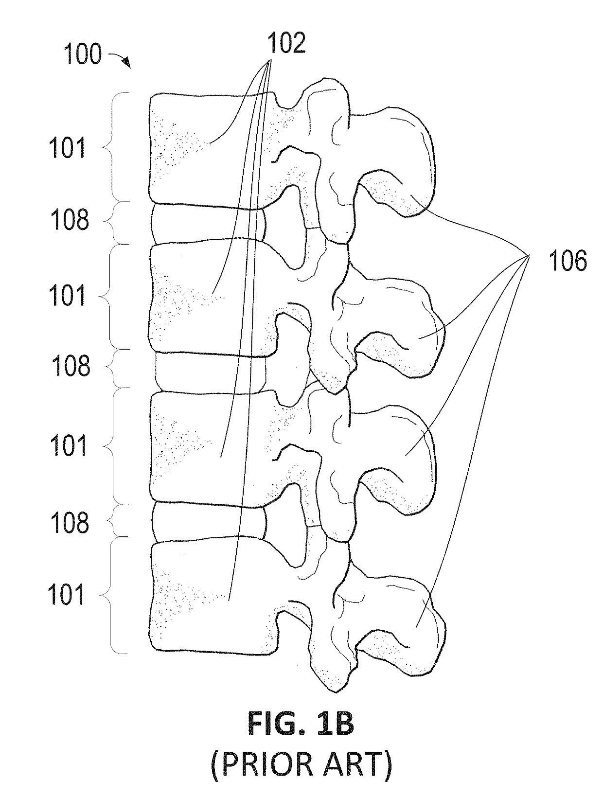 Method and apparatus for inhibiting proximal junctional failure