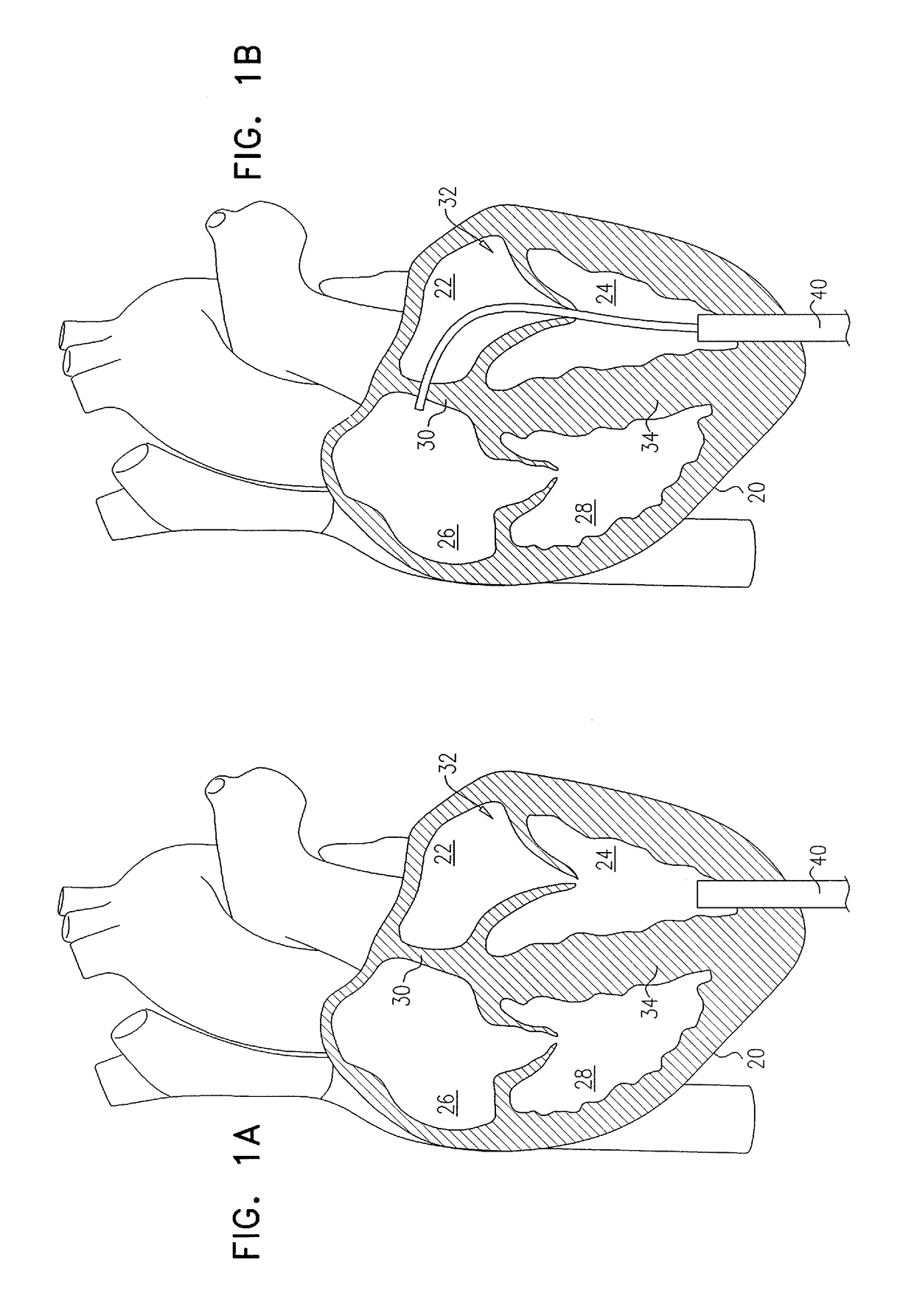 Techniques for providing a replacement valve and transseptal communication