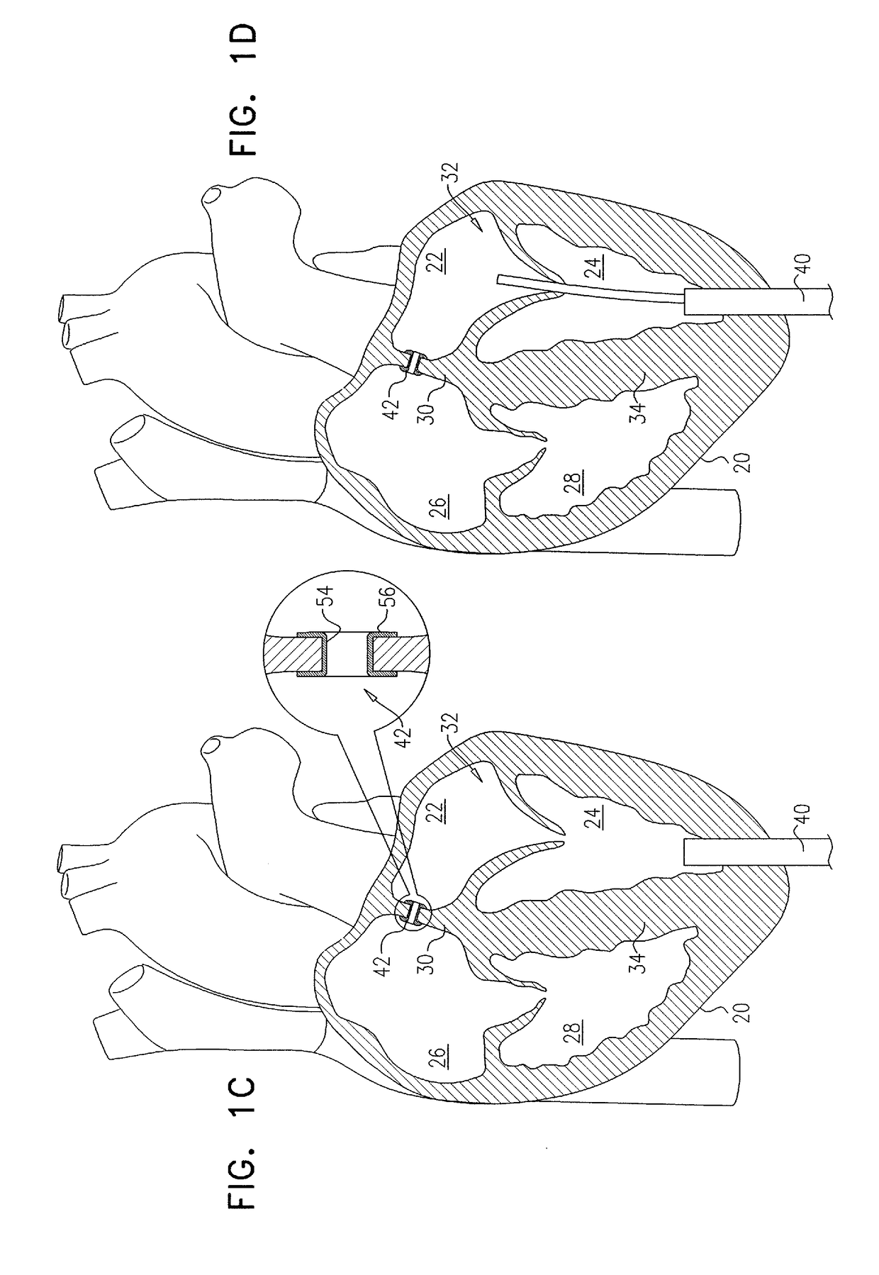 Techniques for providing a replacement valve and transseptal communication