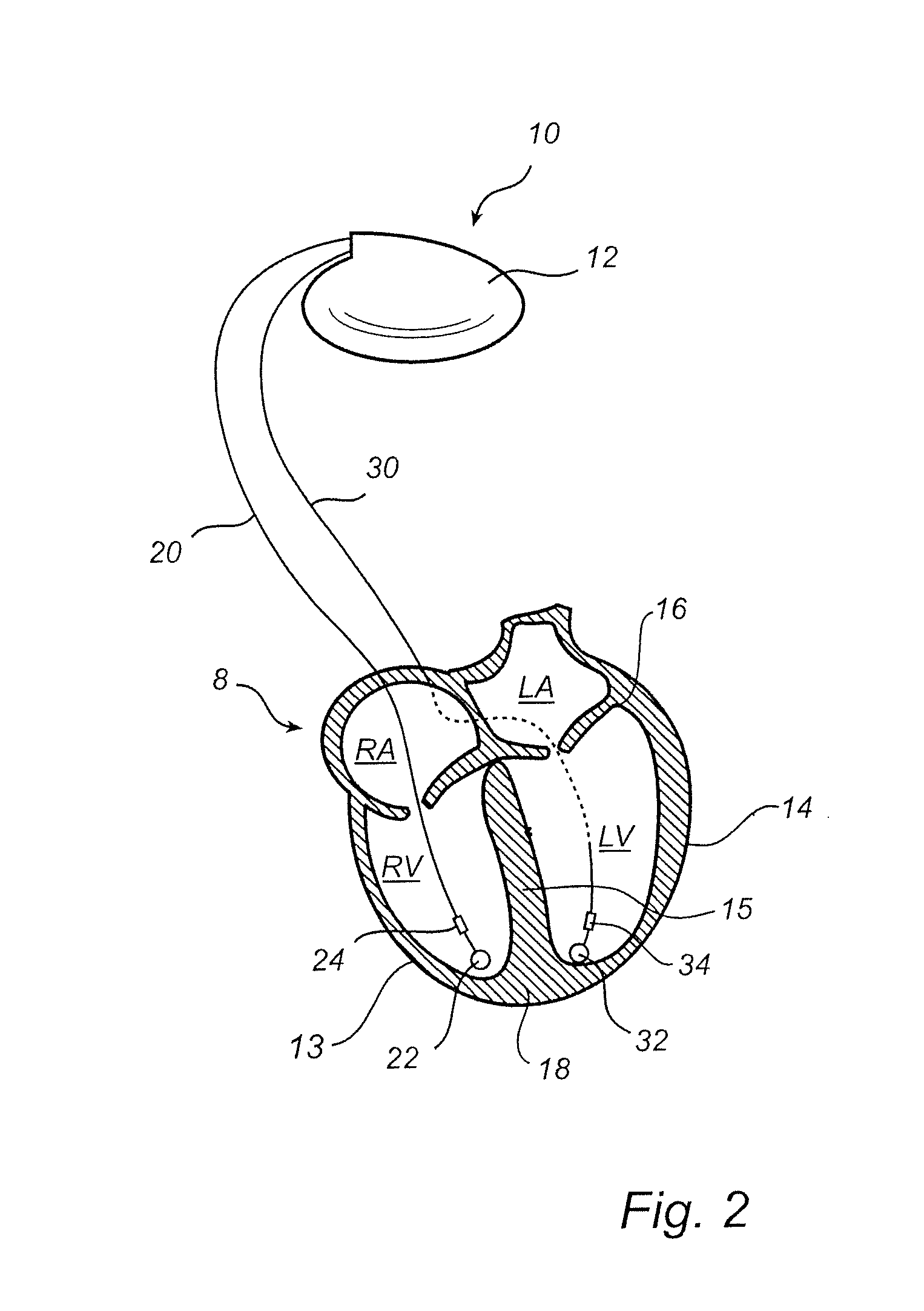 Implantable medical device and method for monitoring synchronicity of the ventricles of a heart