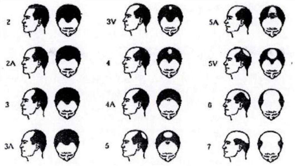 Composition and preparation for improving human alopecia and hair growth as well as preparation method and application