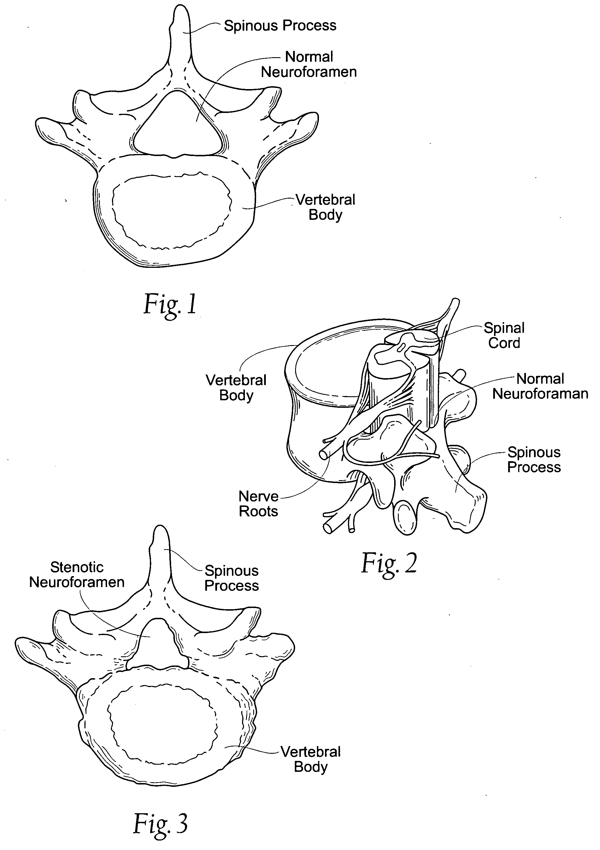 Percutaneous spine distraction implant systems and methods