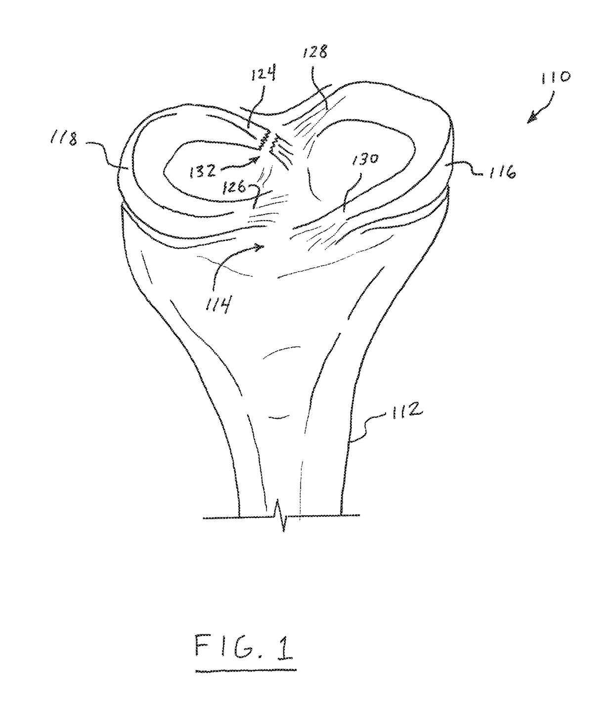 Self-cinching suture construct apparatus