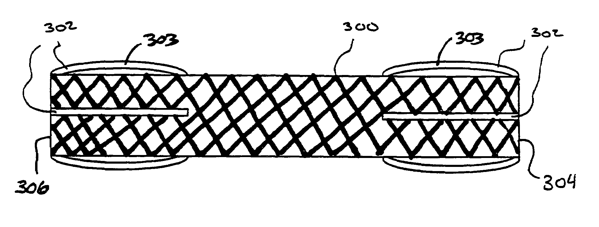 Composite stent with regioselective material and a method of forming the same