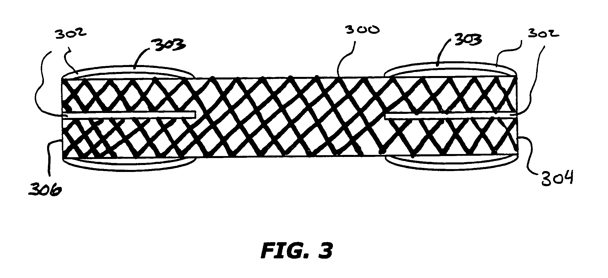 Composite stent with regioselective material and a method of forming the same