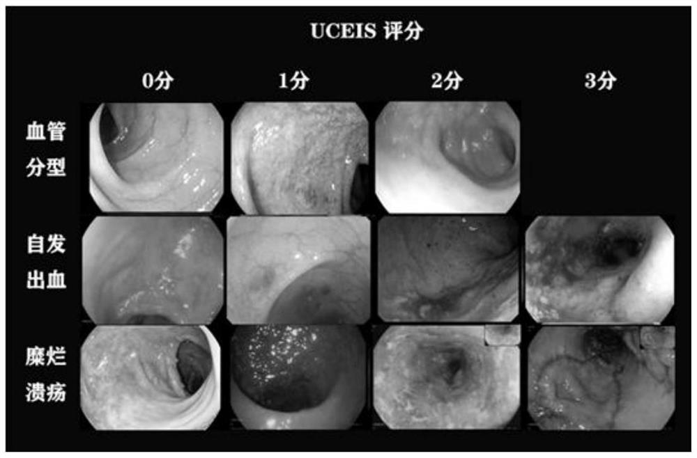 Method and system for evaluating the severity of ulcerative colitis based on deep learning