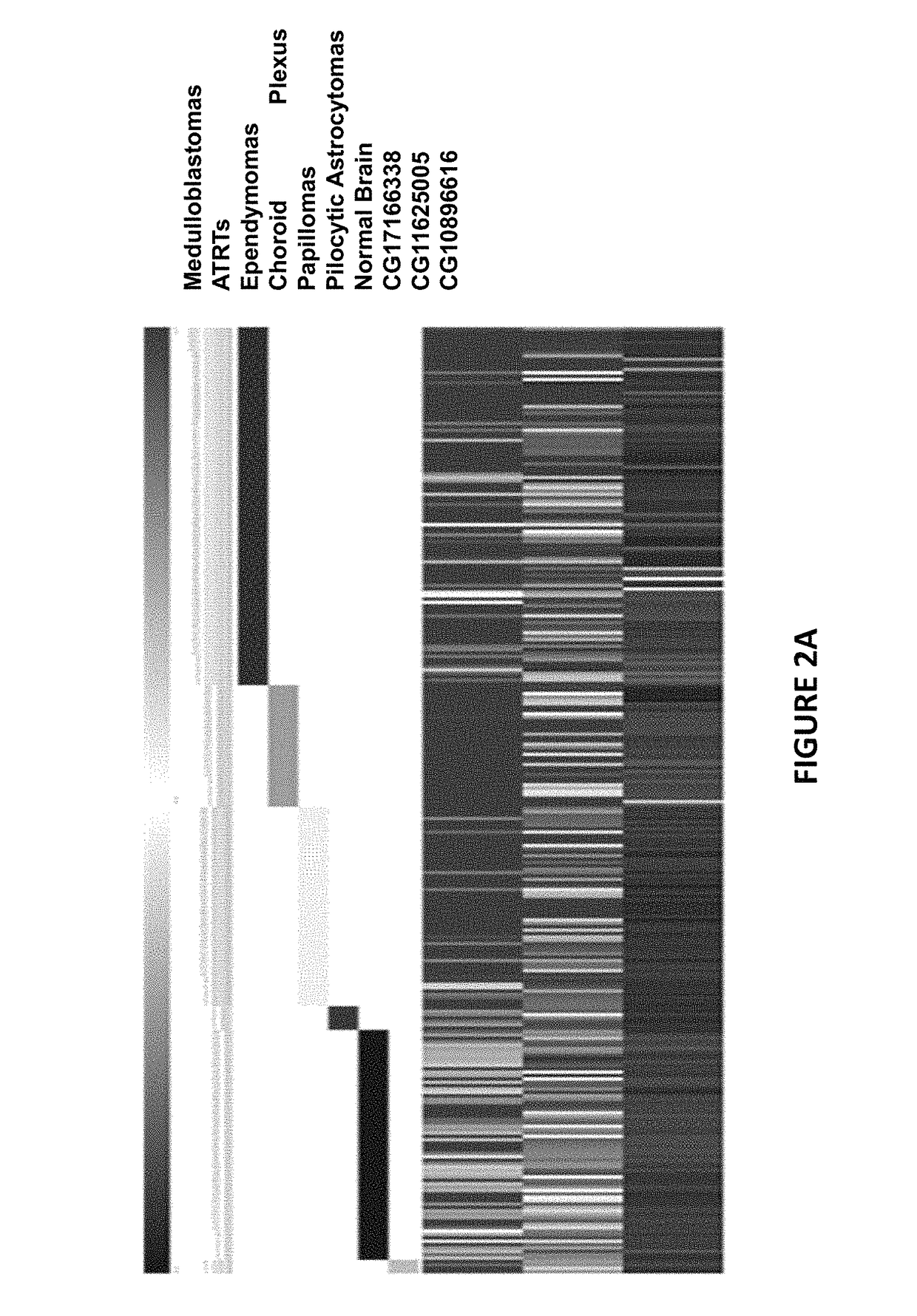 Method of diagnosing cancer comprising detection of the methylation signature in the hTERT promoter