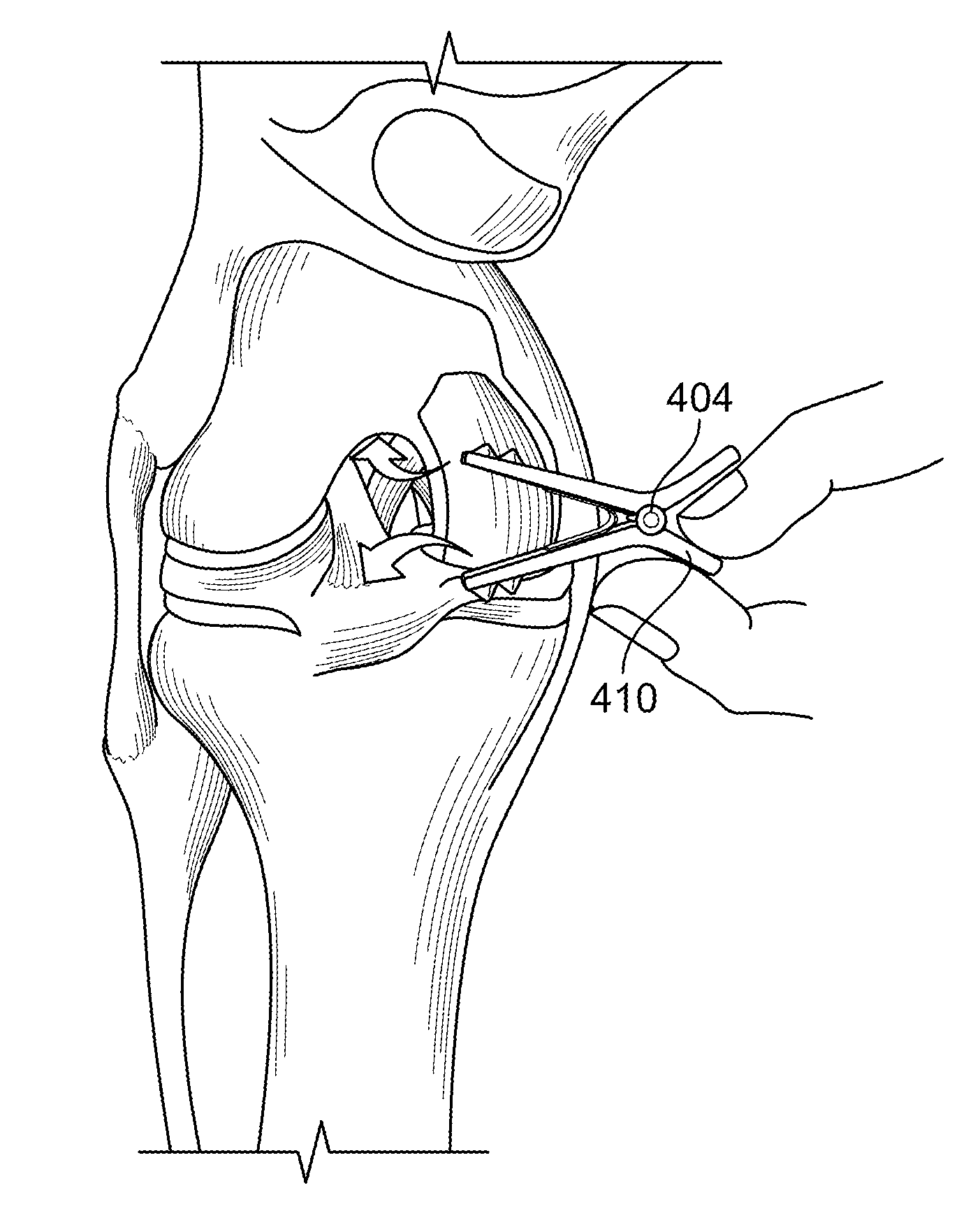 Joint stabilizing instrument and method of use