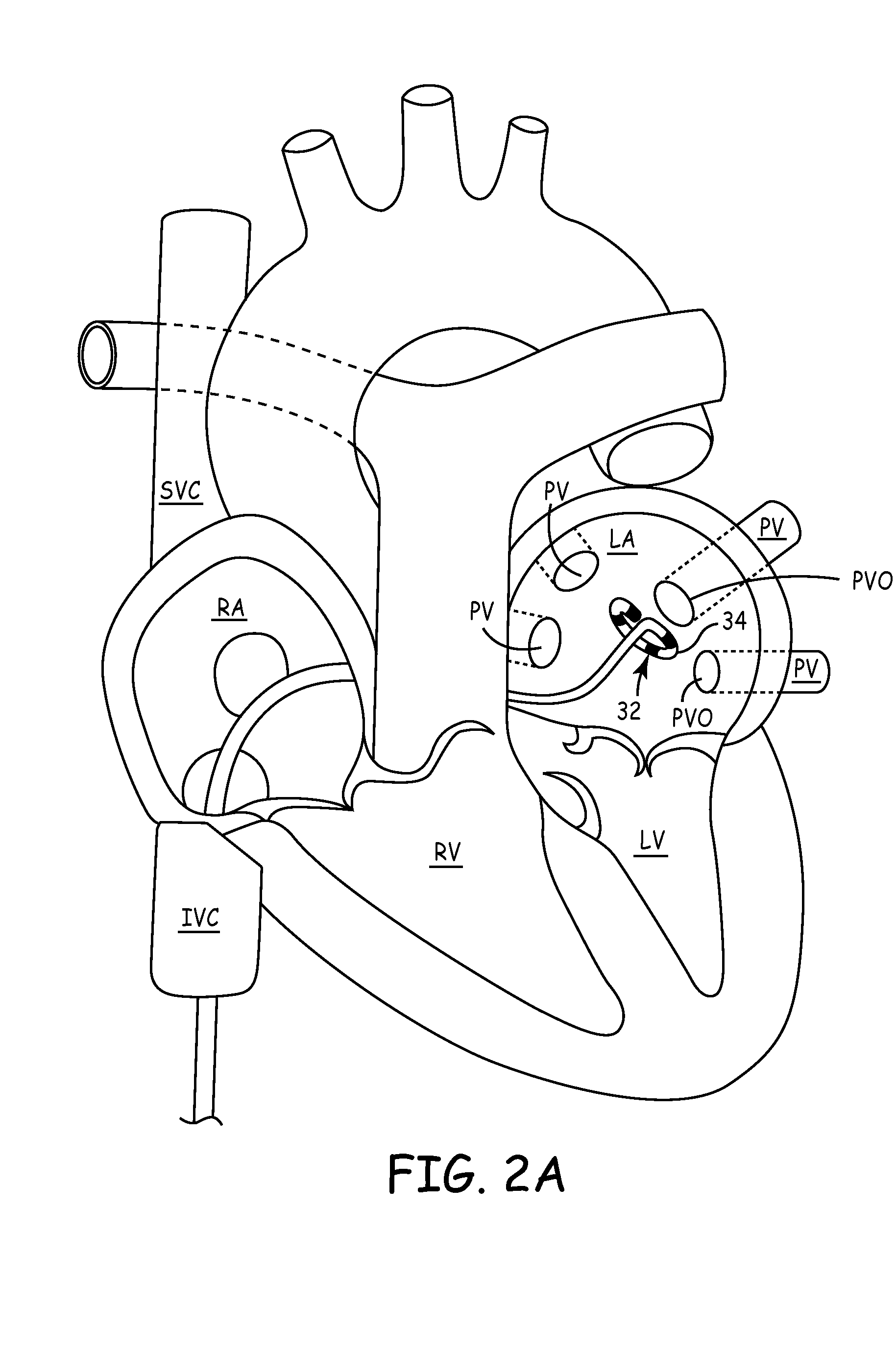 Ablation Catheter Assembly with Radially Decreasing Helix and Method of Use