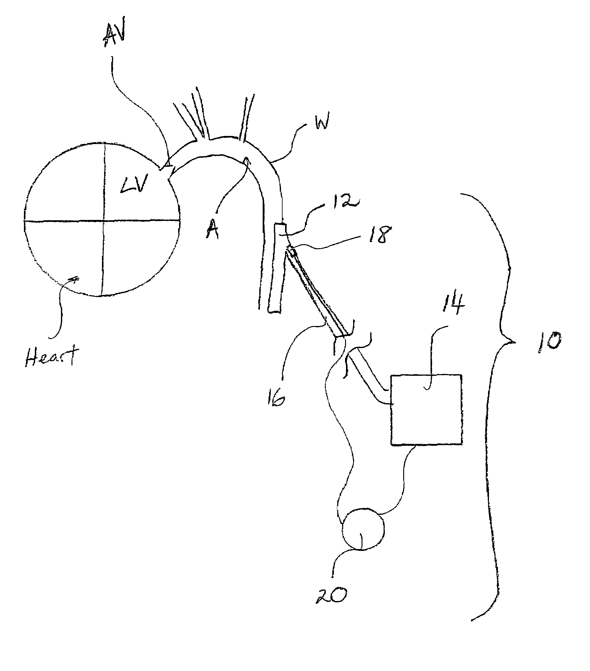 Synchronization system between aortic valve and cardiac assist device