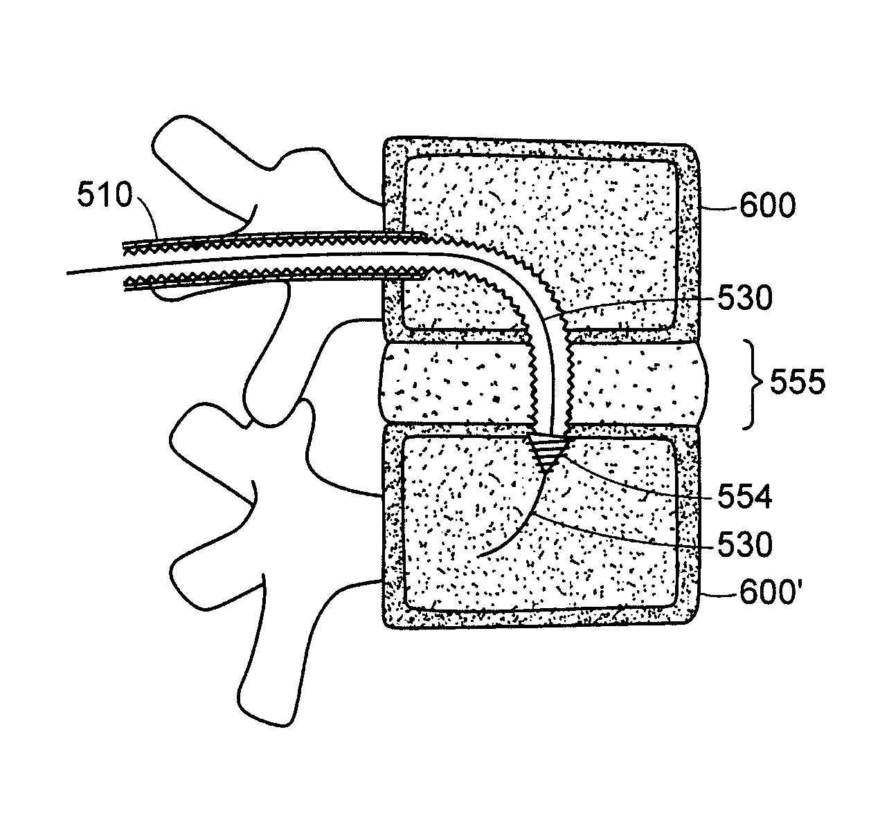 Devices and methods for stabilizing a spinal region