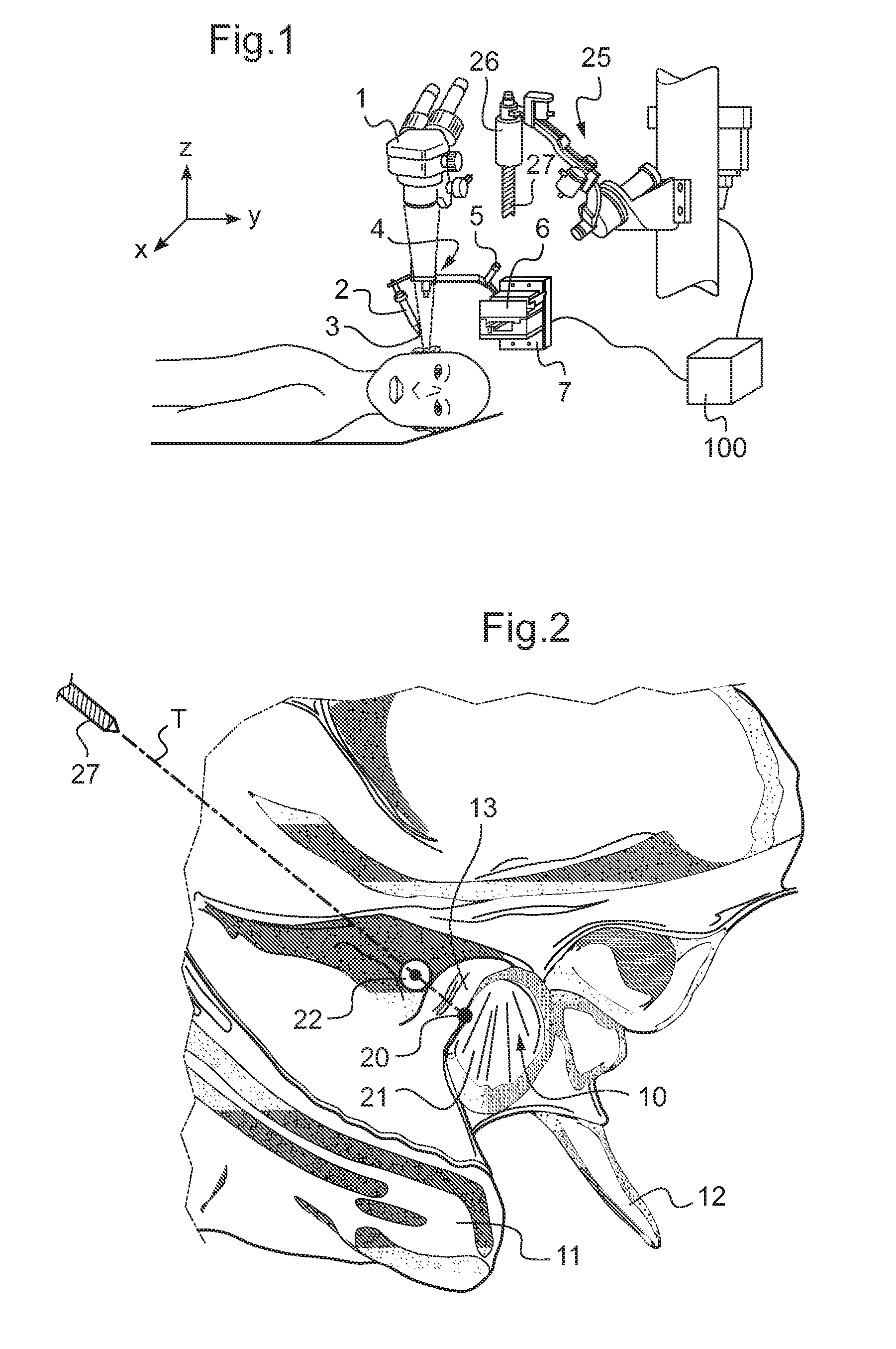 Dispositif d assistance a la chirurgie otologique d un patient a implanter avec un implant cochleaire