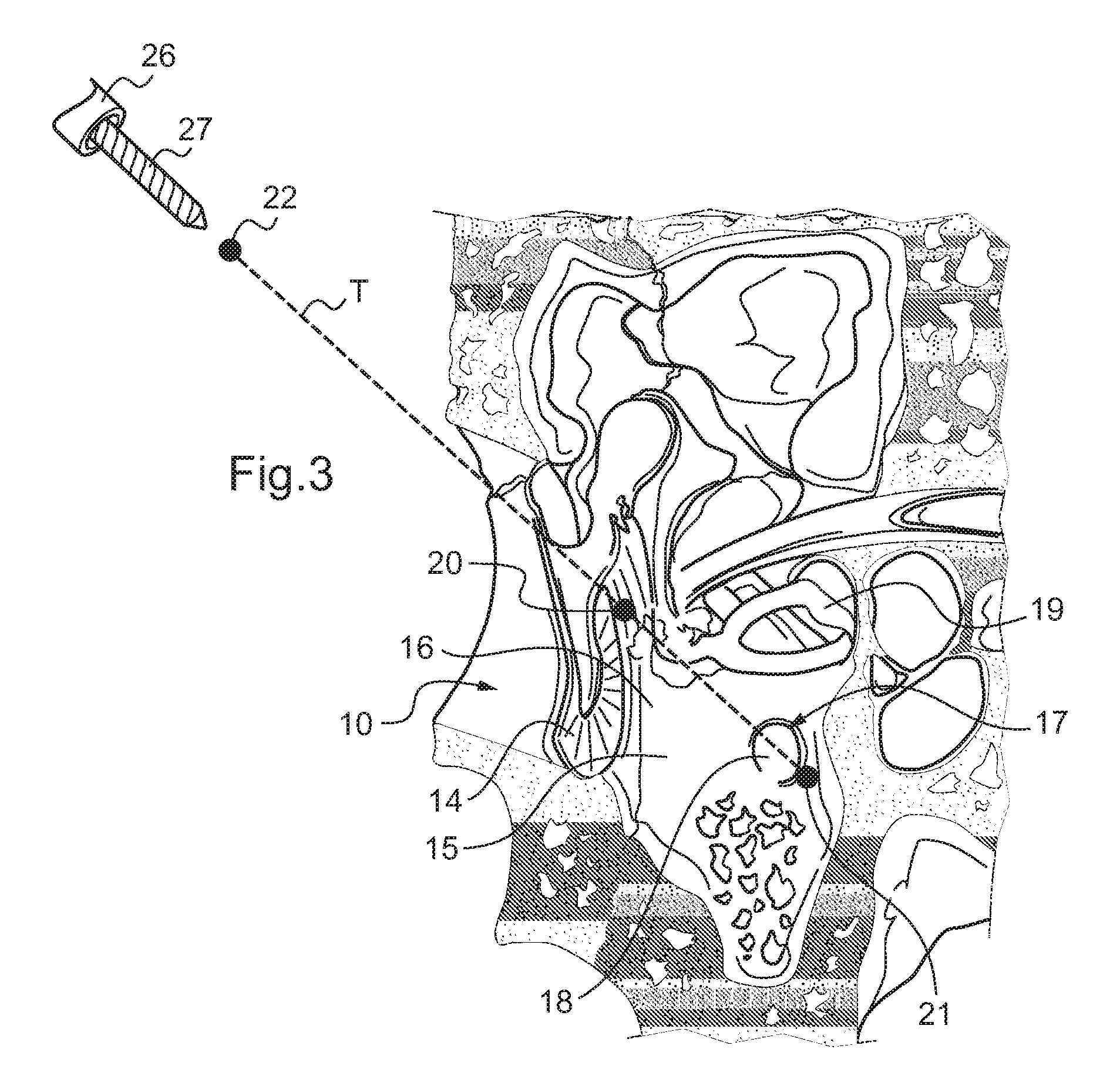 Dispositif d assistance a la chirurgie otologique d un patient a implanter avec un implant cochleaire