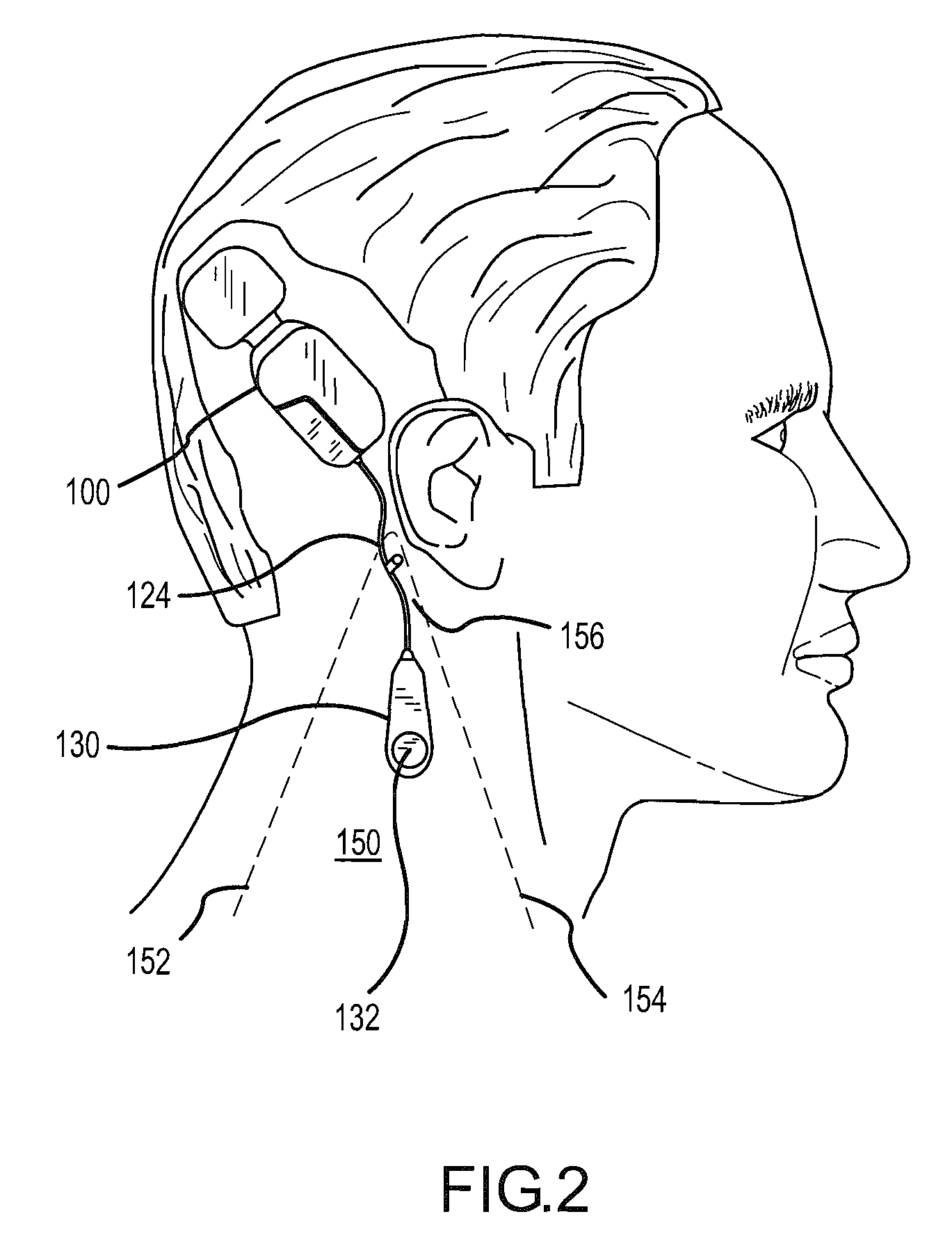 Soft tissue placement of implantable microphone