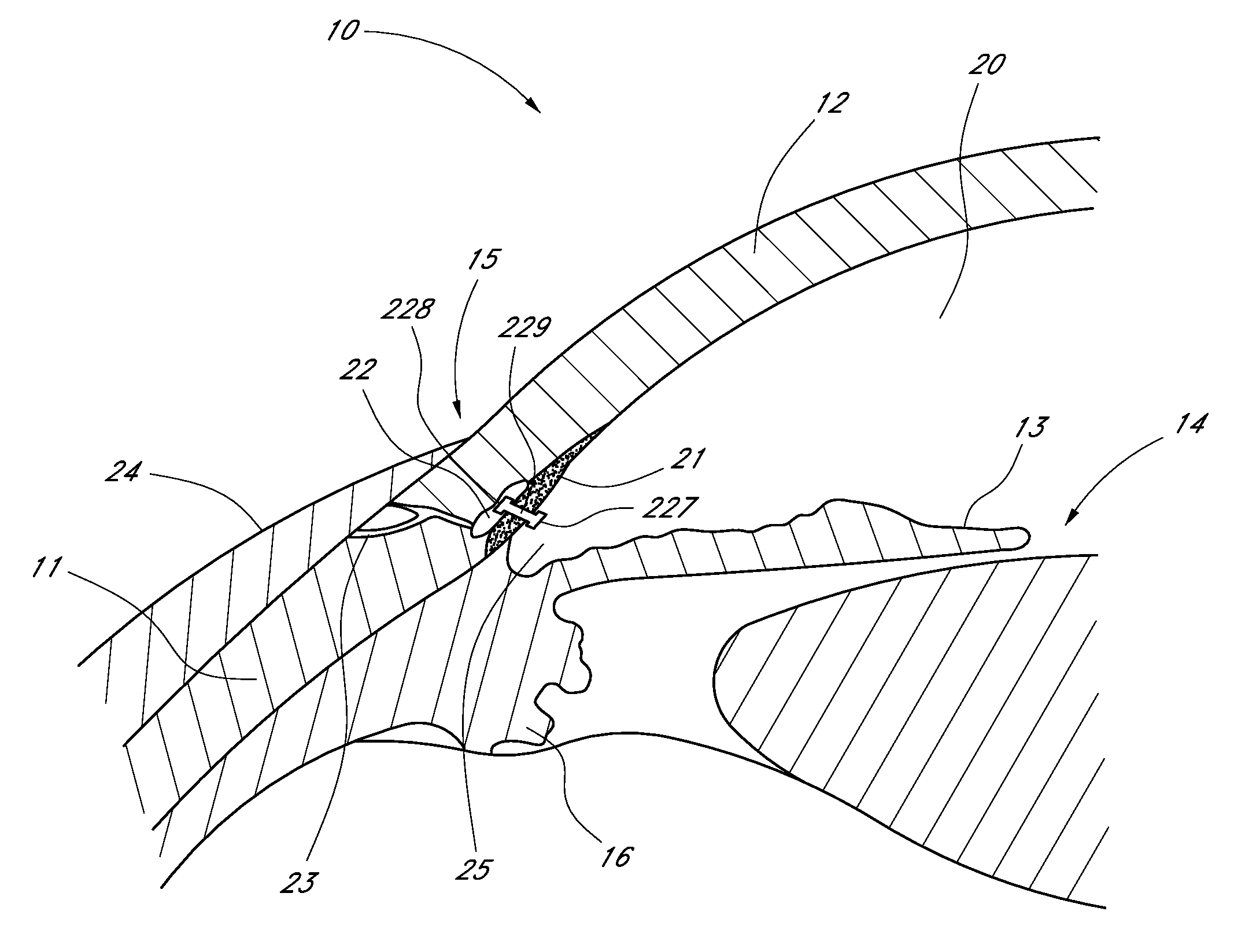 Ocular implant with therapeutic agents and methods thereof