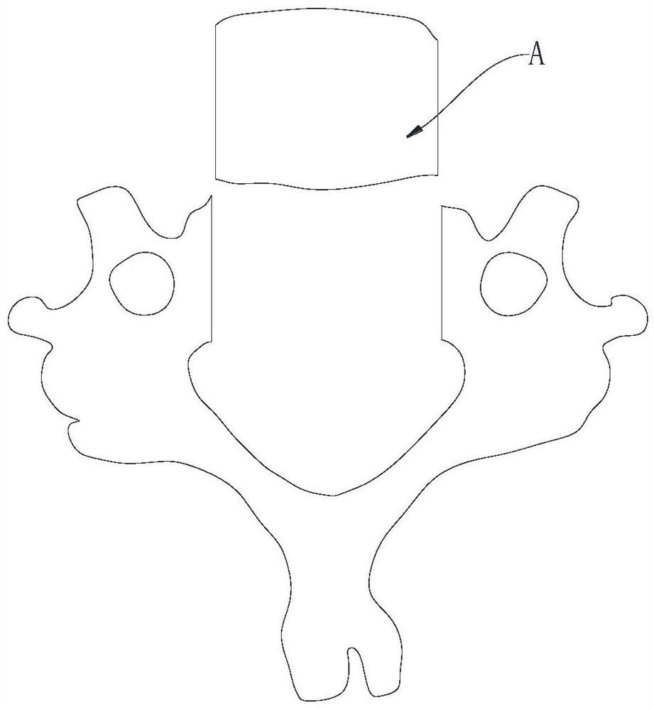 Vertebral x-shape resection decompression vertebroplasty intervertebral fusion fixator