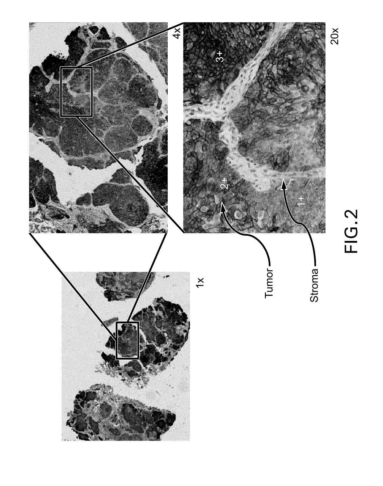 Immunohistochemical assay for detecting expression of programmed death ligand 1 (pd-l1) in tumor tissue