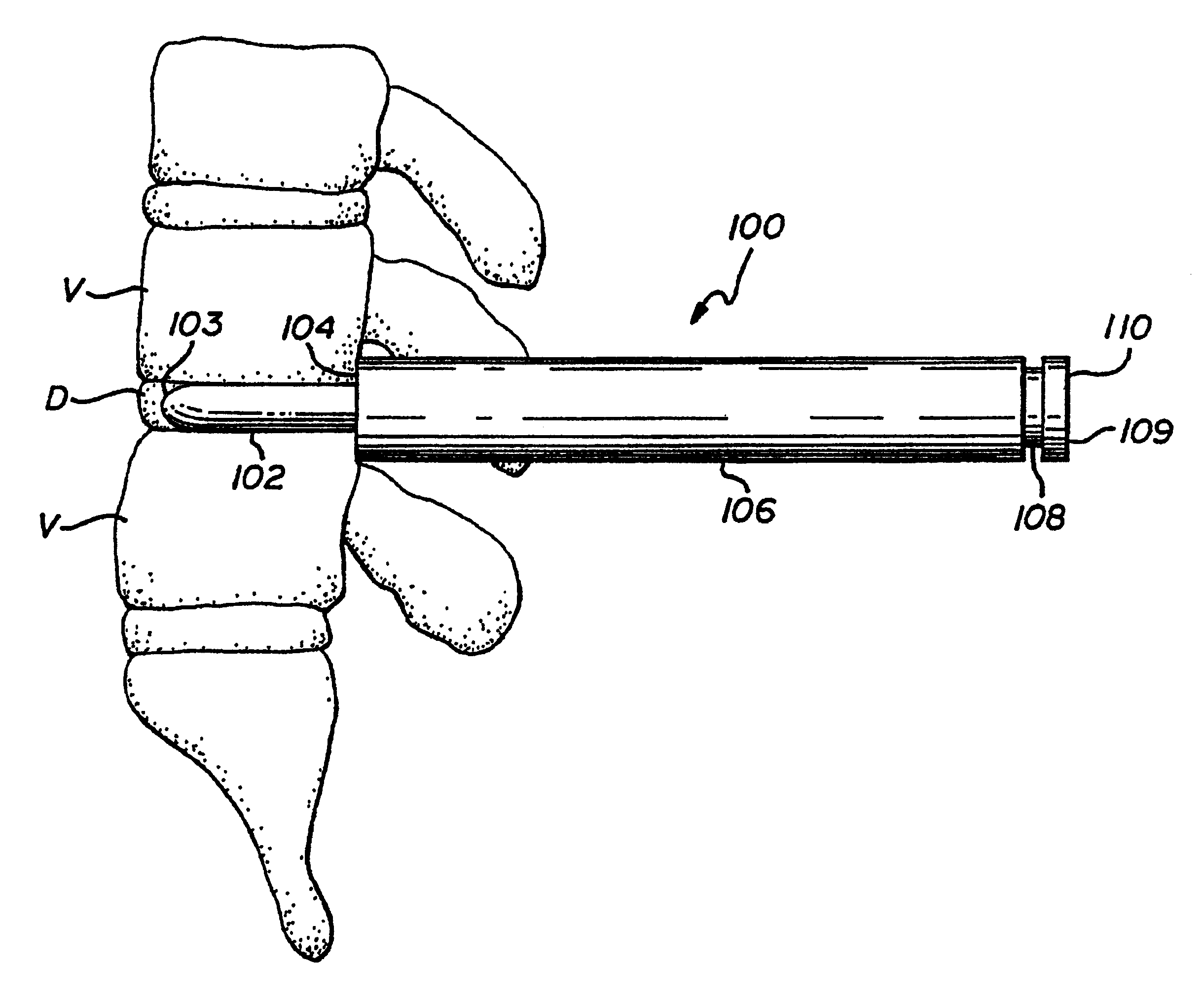 Method for inserting spinal implants and for securing a guard to the spine