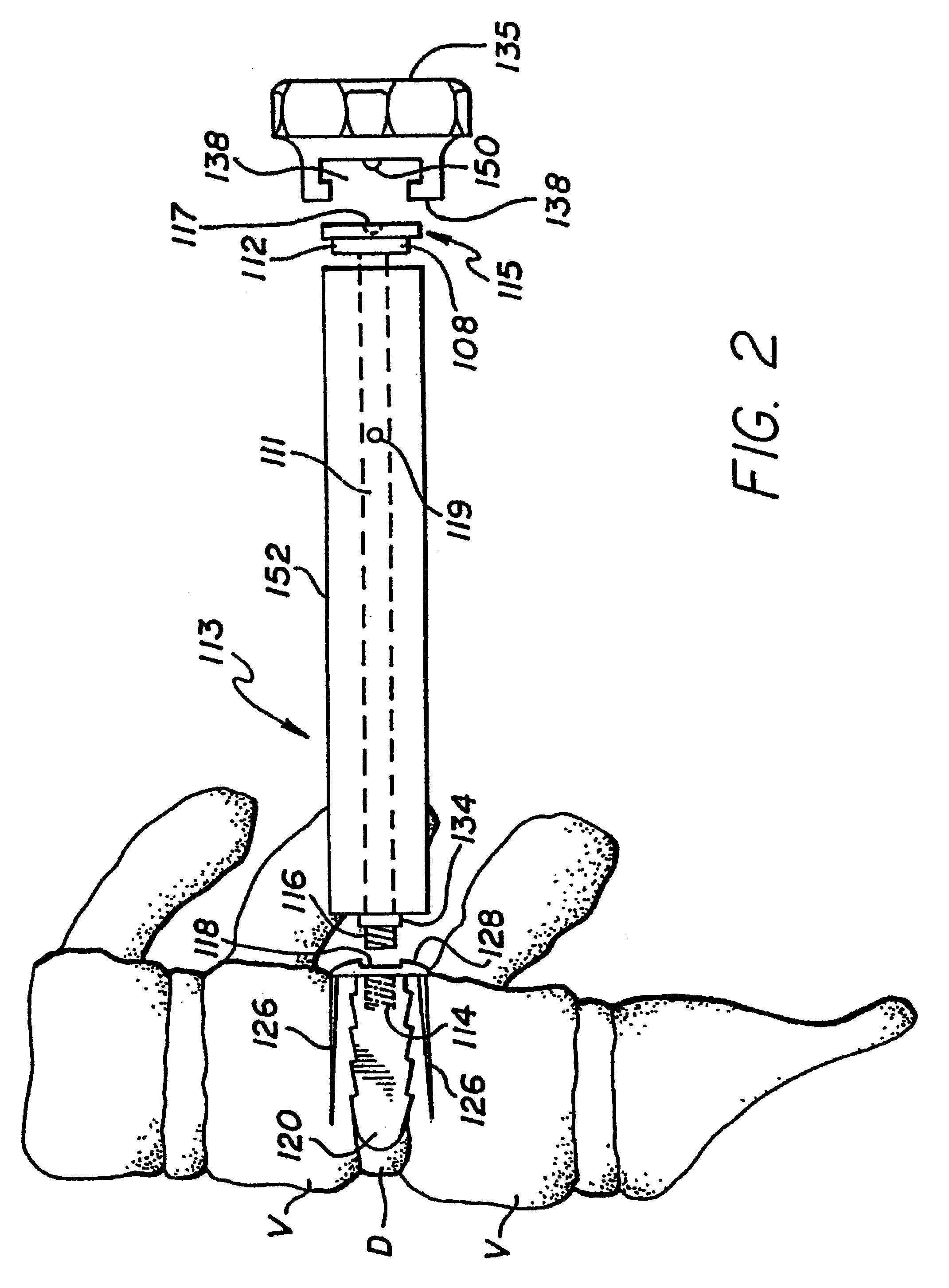 Method for inserting spinal implants and for securing a guard to the spine