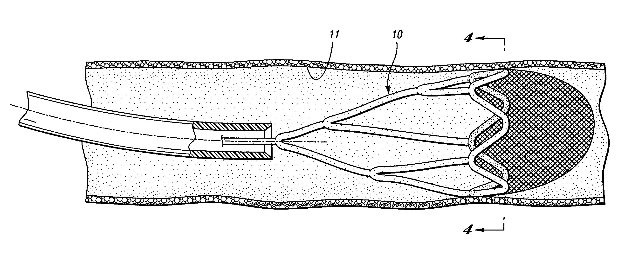 Embolic protection device having a reticulated body with staggered struts