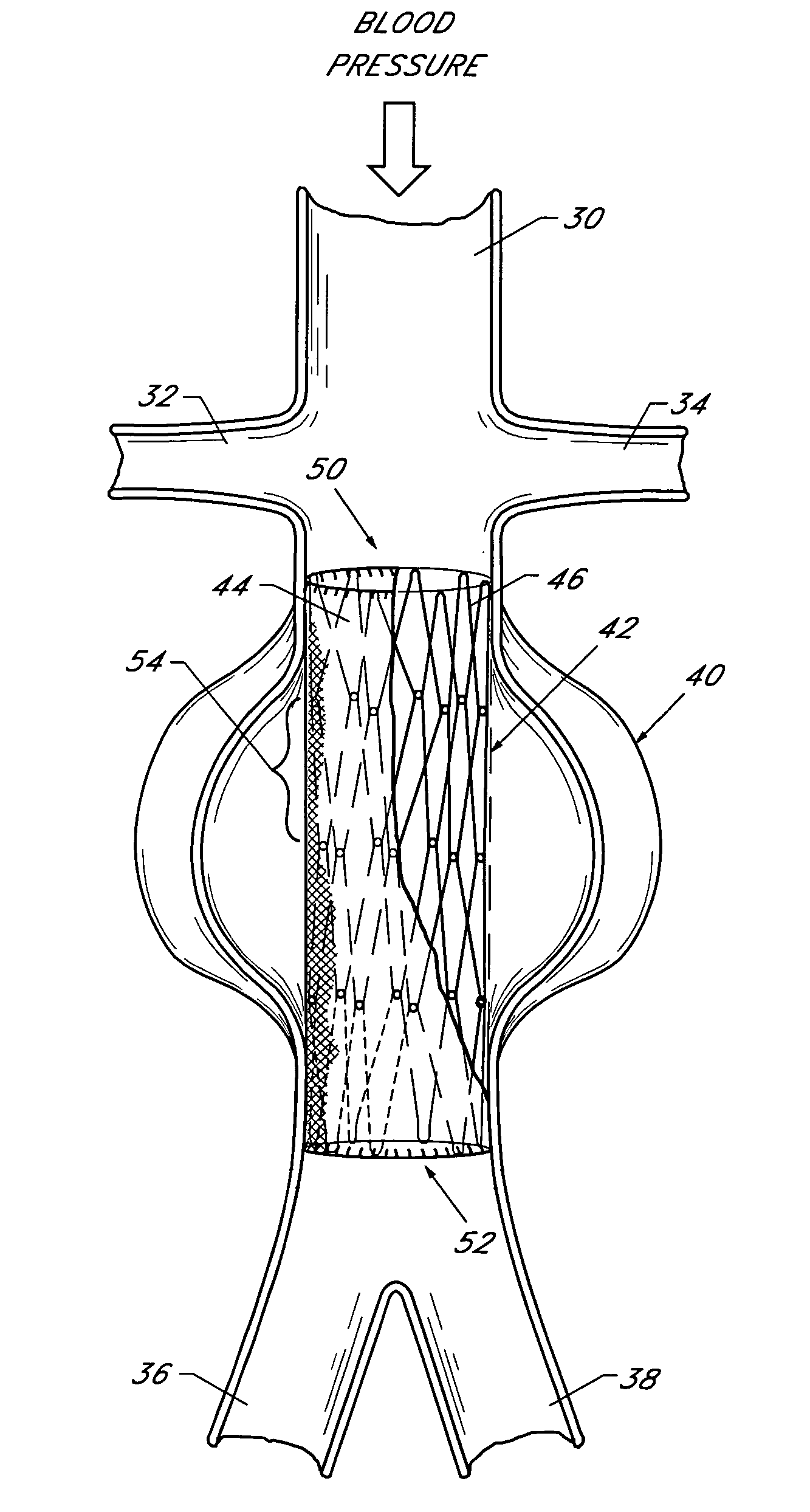 Endolumenal vascular prosthesis with neointima inhibiting polymeric sleeve