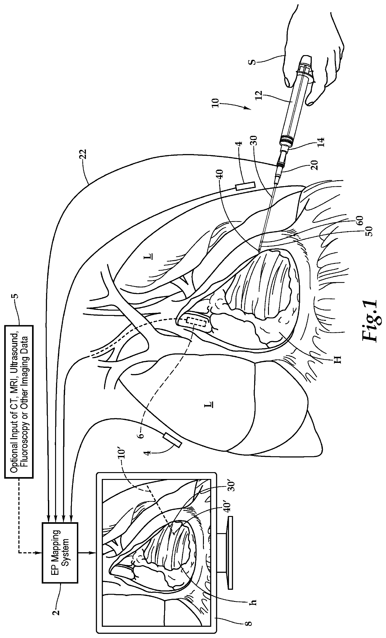 Pericardiocentesis needle guided by cardiac electrophysiology mapping