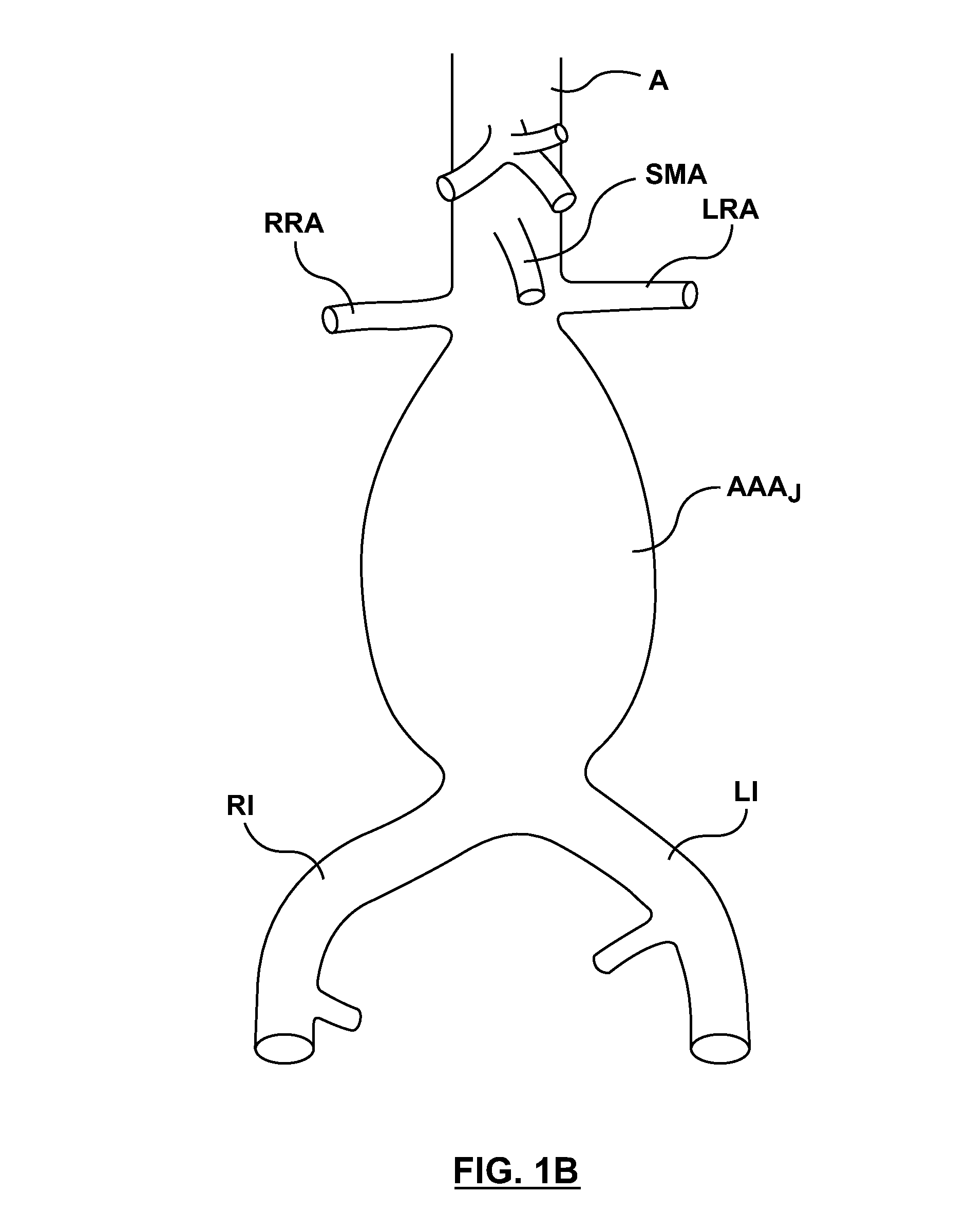 Stent-graft prosthesis for placement in the abdominal aorta