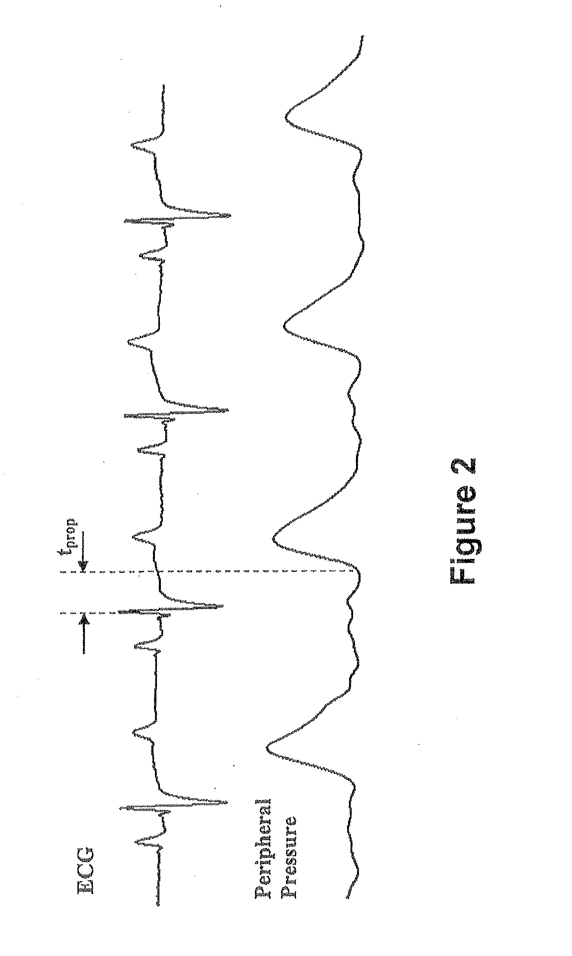 Method and Apparatus for Continuous Assessment of a Cardiovascular Parameter Using the Arterial Pulse Pressure Propagation Time and Waveform