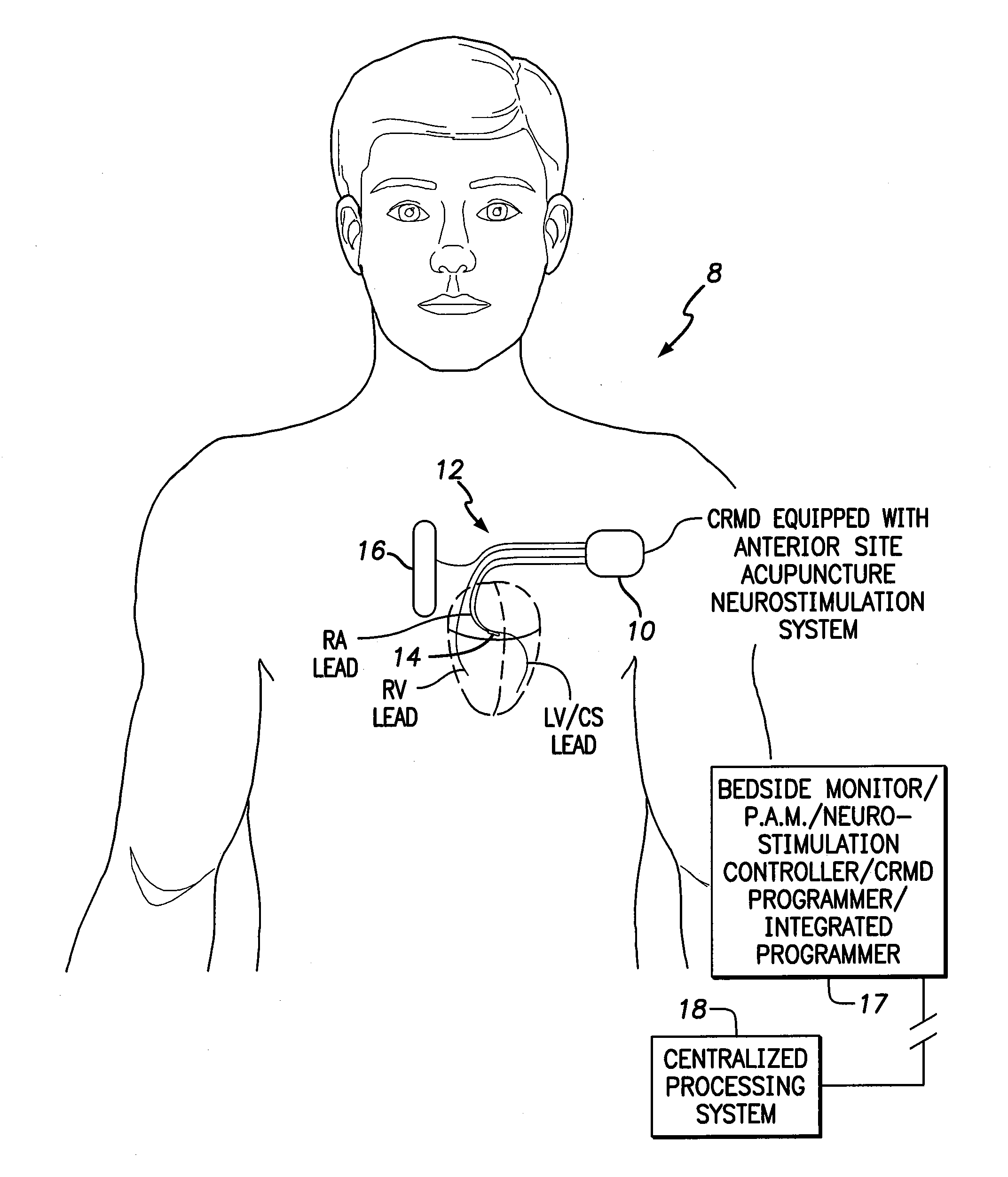 Systems and methods for controlling neurostimulation of acupuncture sites using an implantable cardiac rhythm management device