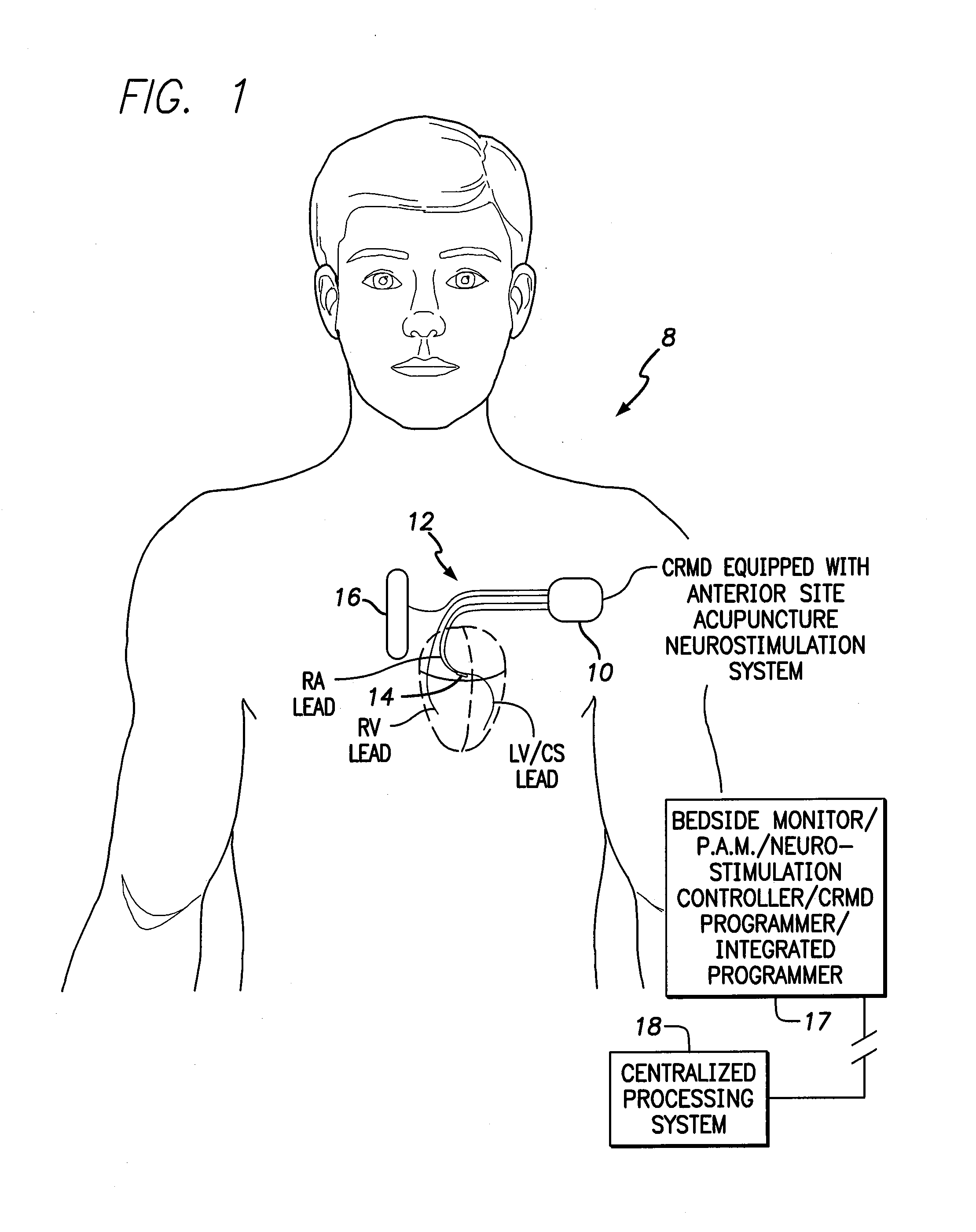 Systems and methods for controlling neurostimulation of acupuncture sites using an implantable cardiac rhythm management device