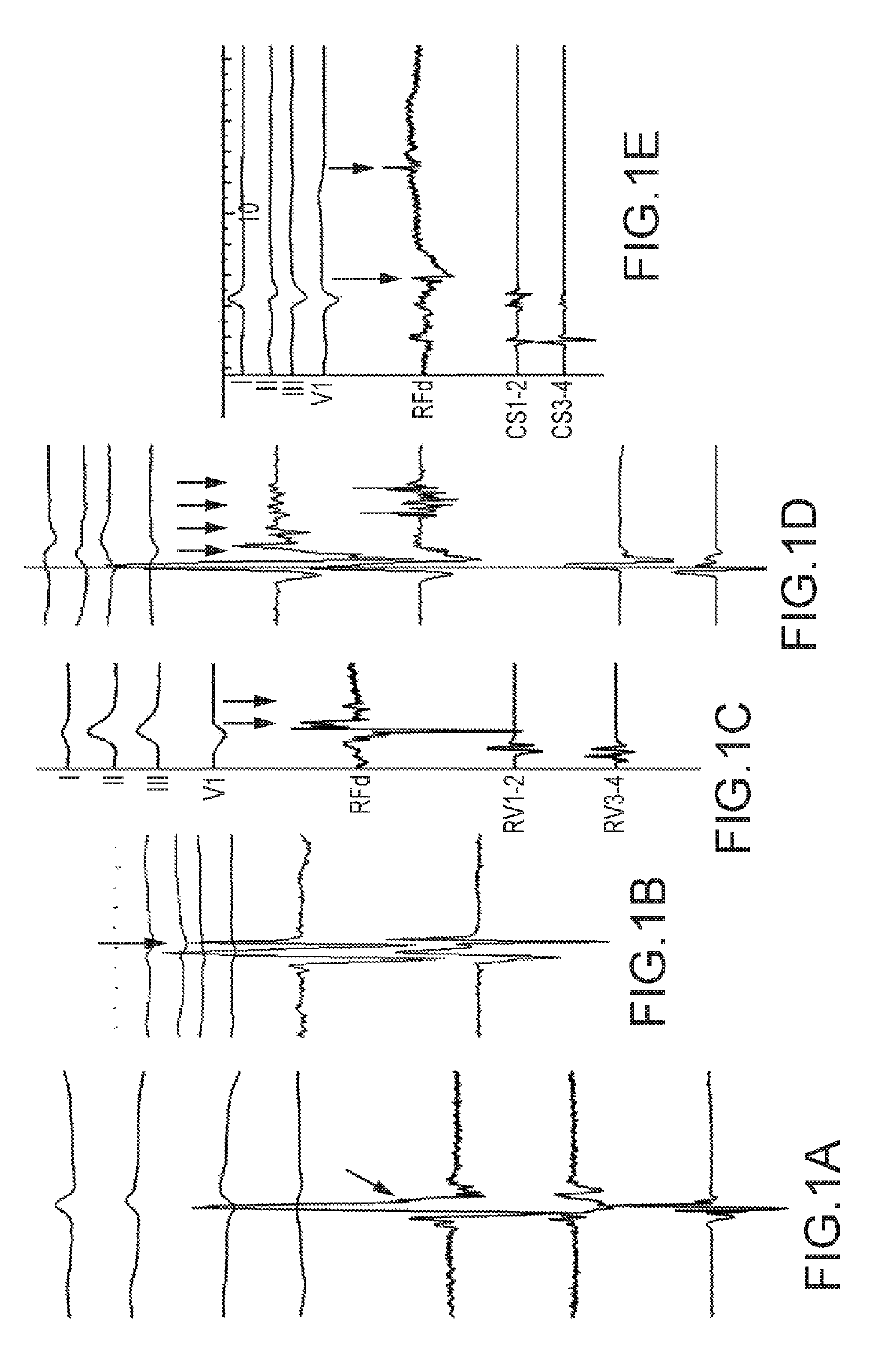 Methods and systems for statistically analyzing electrograms for local abnormal ventricular activities and mapping the same