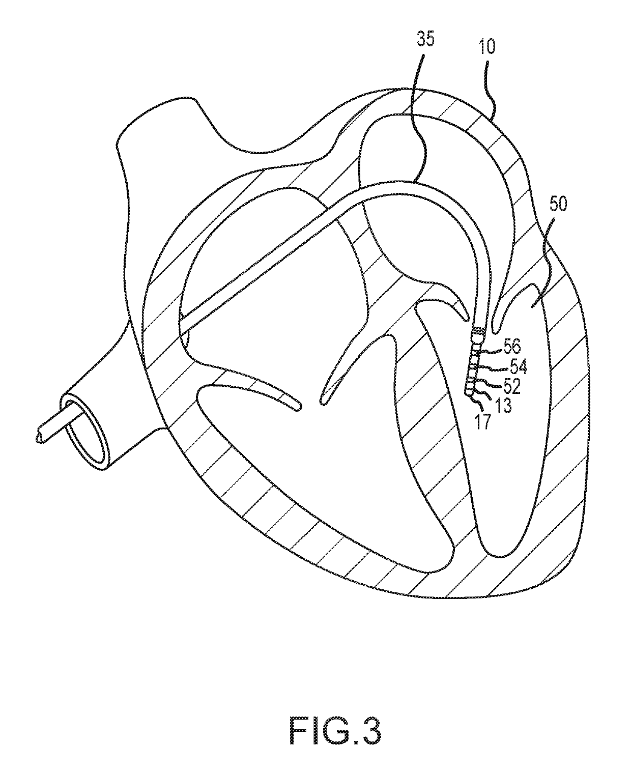 Methods and systems for statistically analyzing electrograms for local abnormal ventricular activities and mapping the same