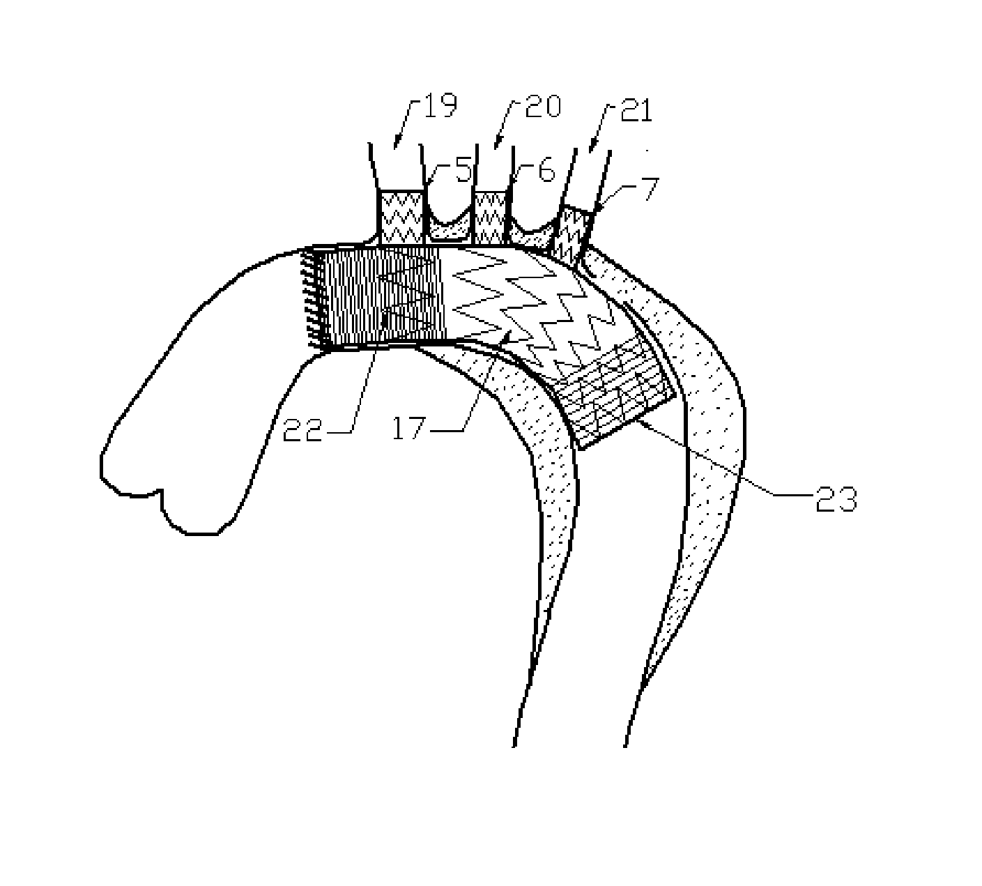 Aortic Arch Intraoperative Stent and Manufacturing Method Thereof