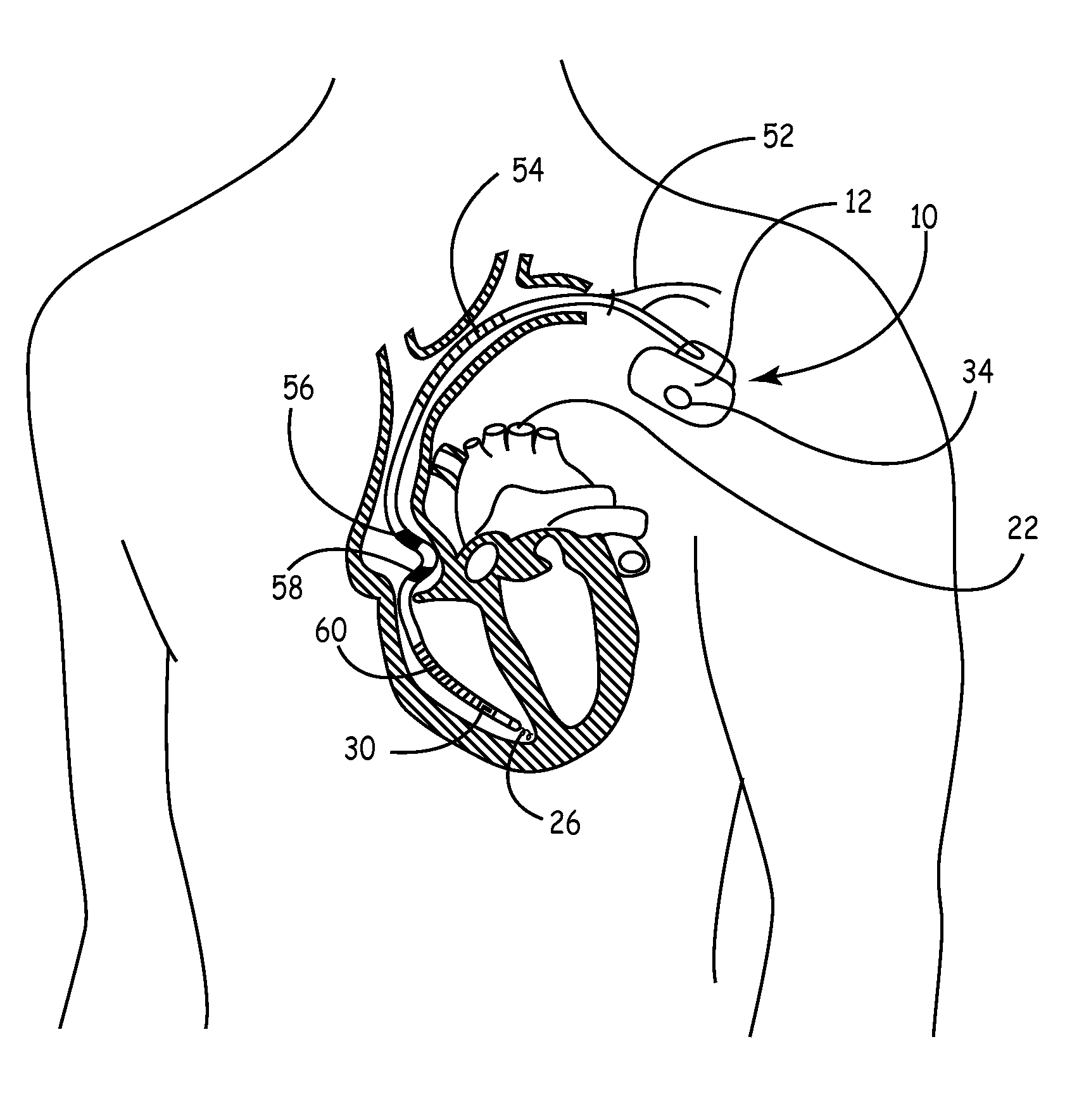 Pressure and Impedance Based Discrimination of Hemodynamic Stability