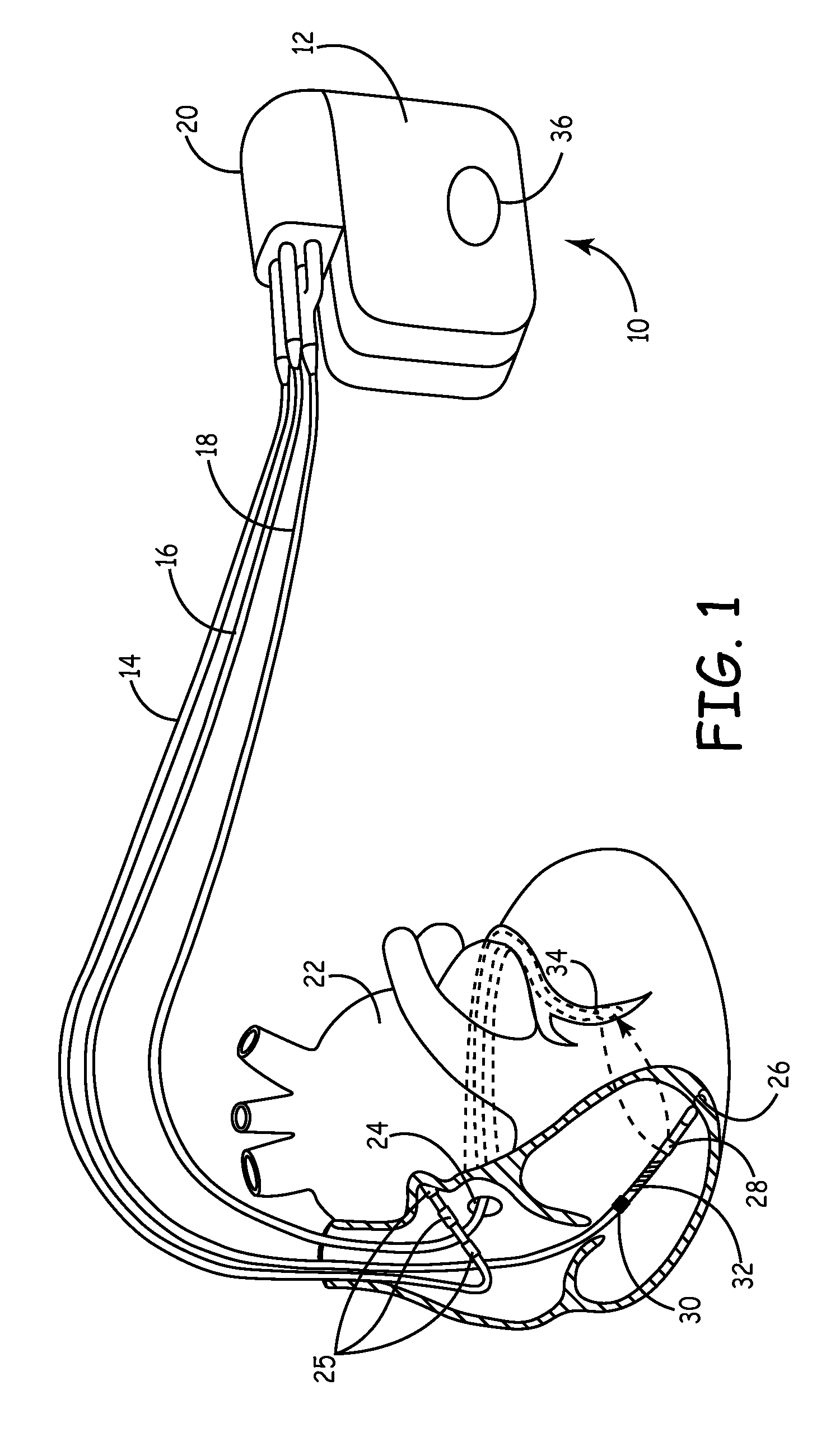 Pressure and Impedance Based Discrimination of Hemodynamic Stability