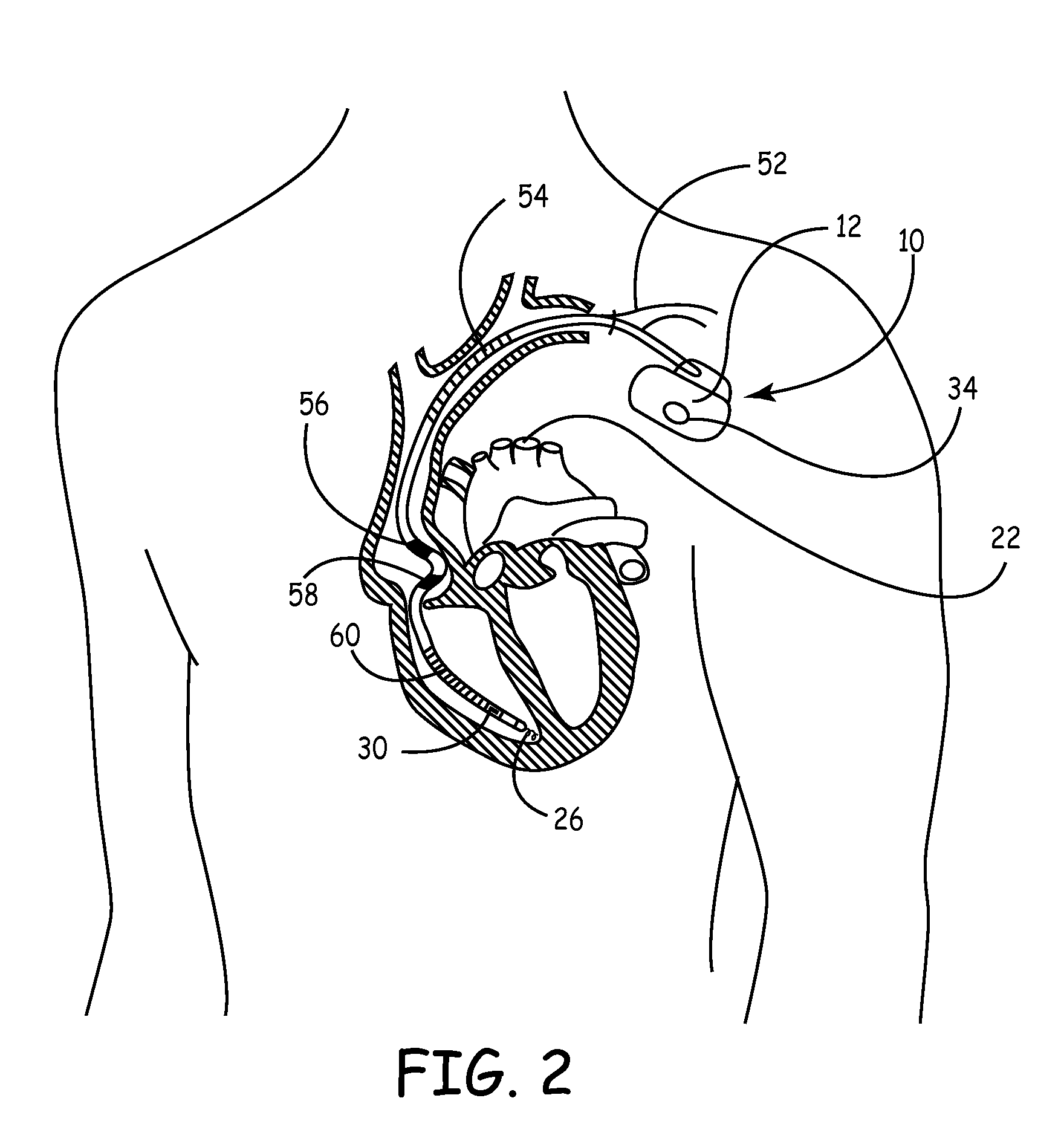 Pressure and Impedance Based Discrimination of Hemodynamic Stability